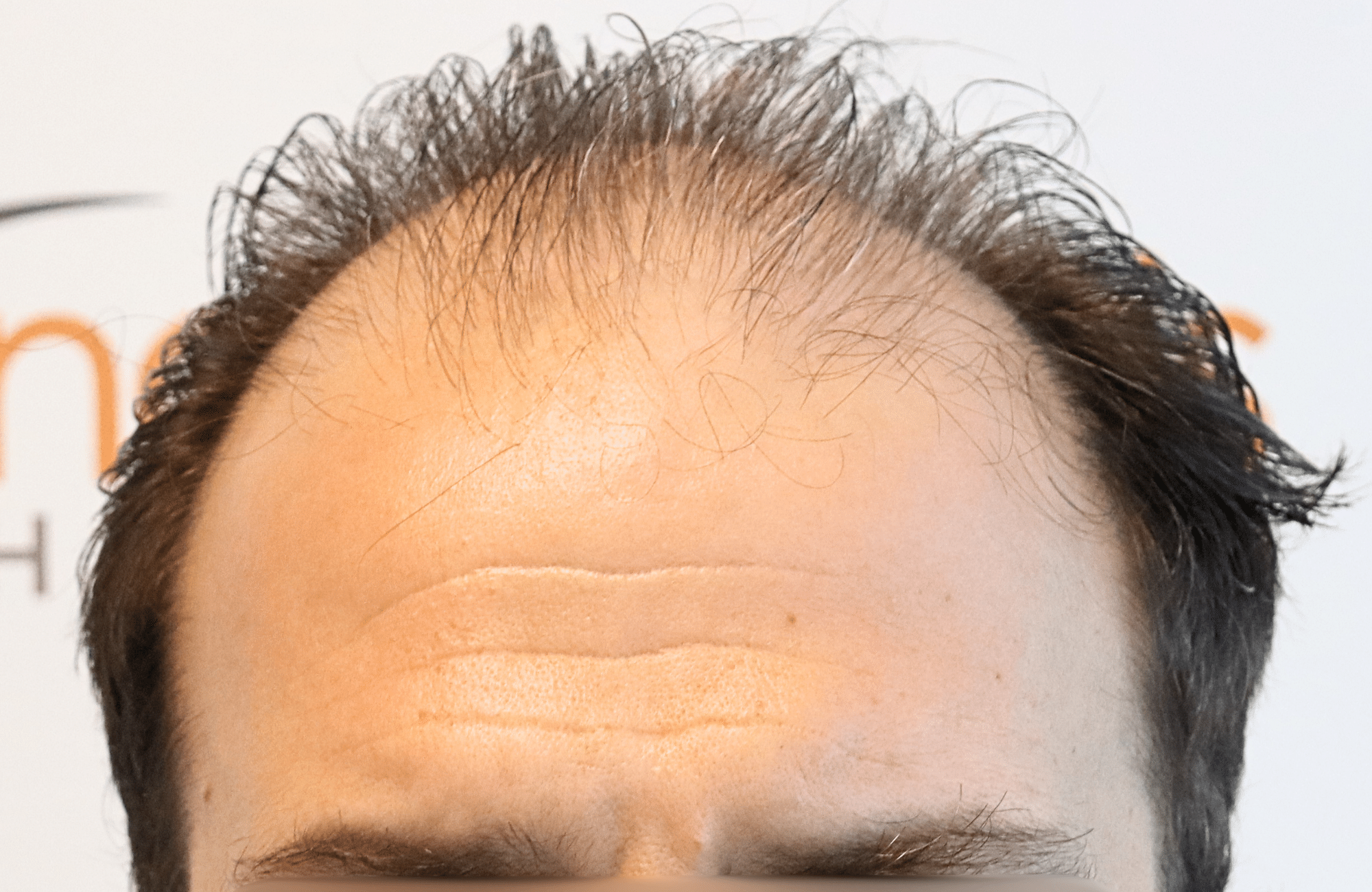 hair transplant 2600 fus thin 1st stage