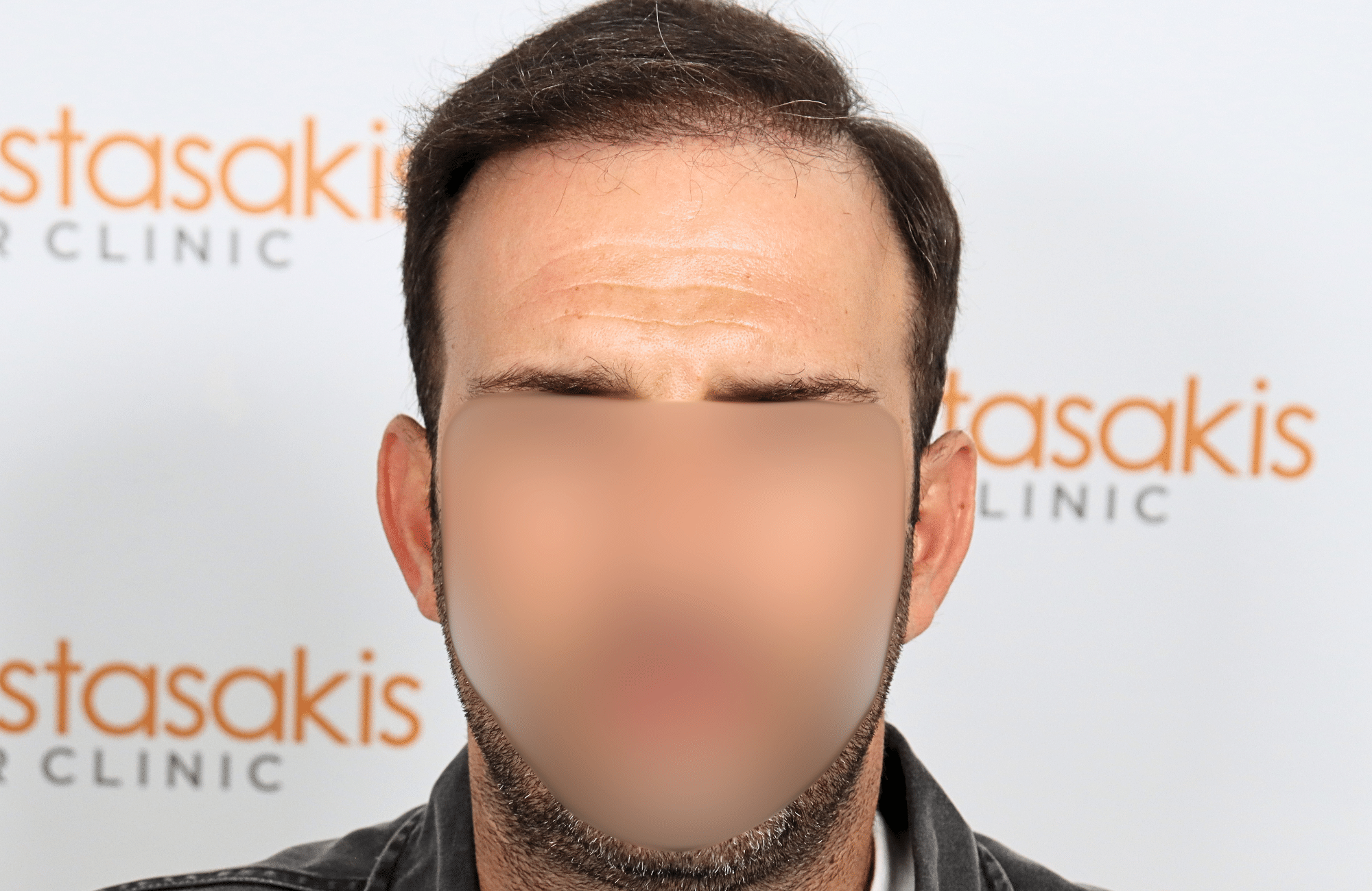 hair transplant 2600 fus thin 1st stage