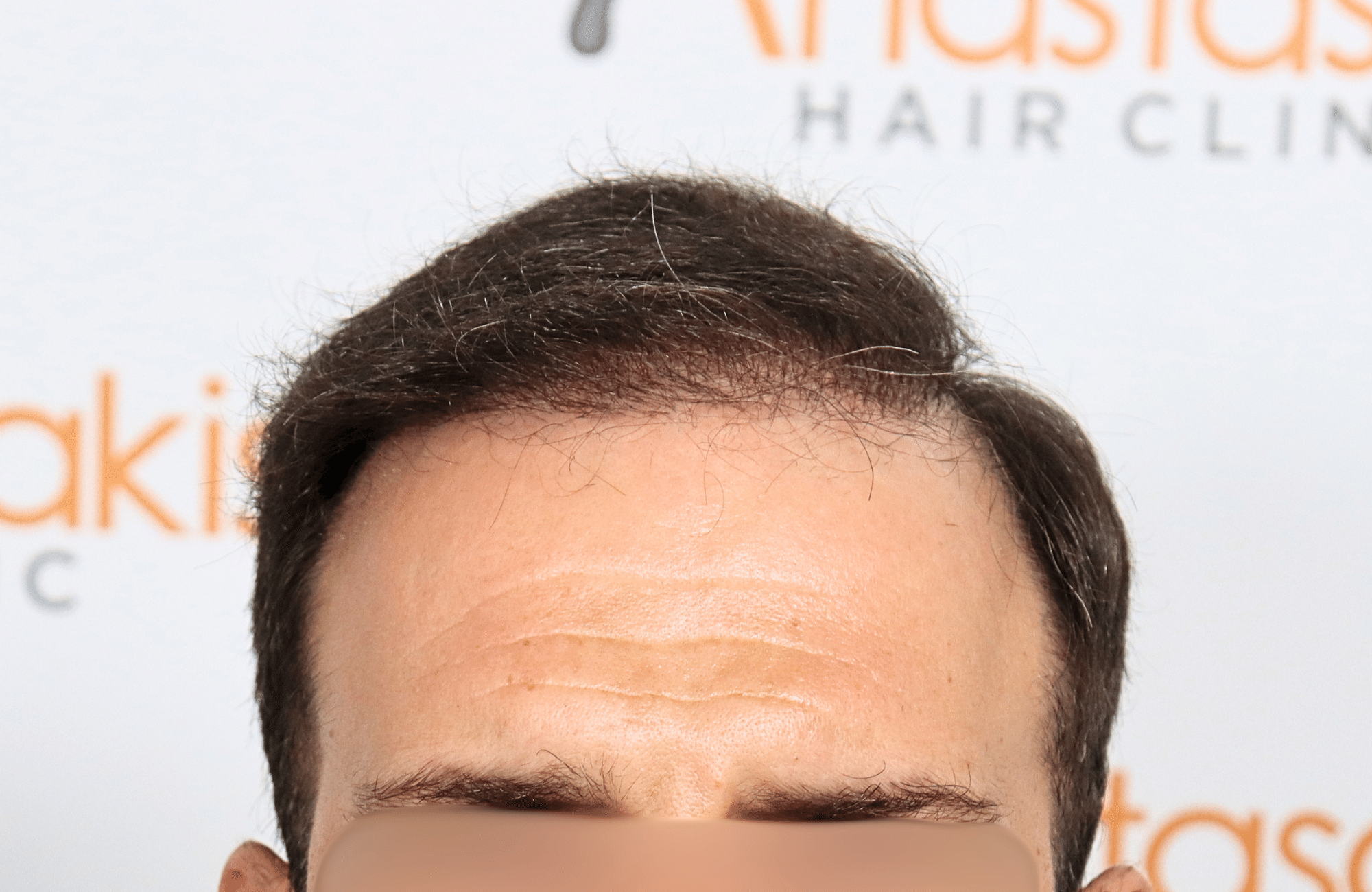 hair transplant 2600 fus thin 1st stage