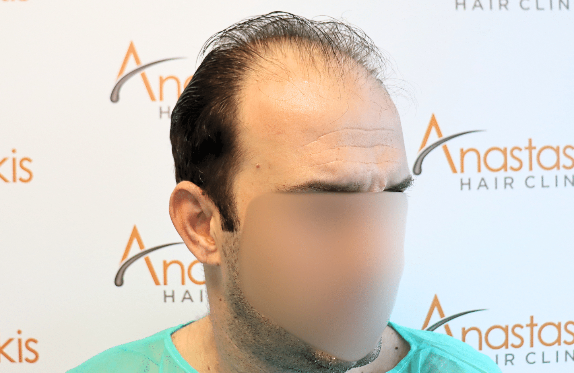 hair transplant 2600 fus thin 1st stage
