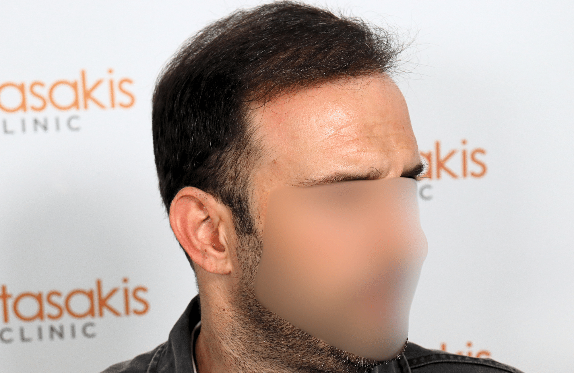 hair transplant 2600 fus thin 1st stage