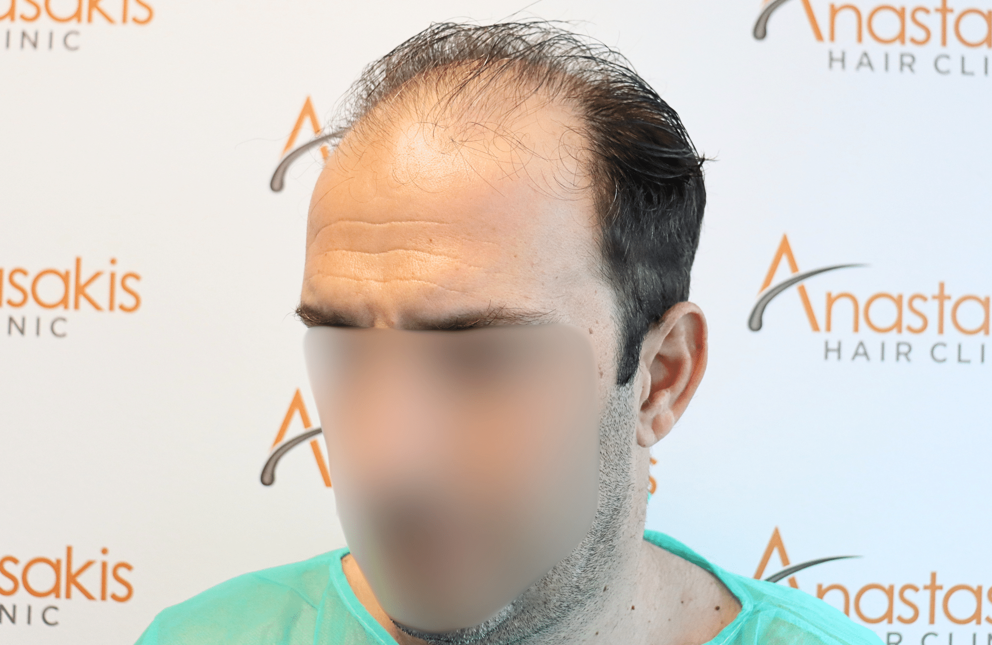hair transplant 2600 fus thin 1st stage