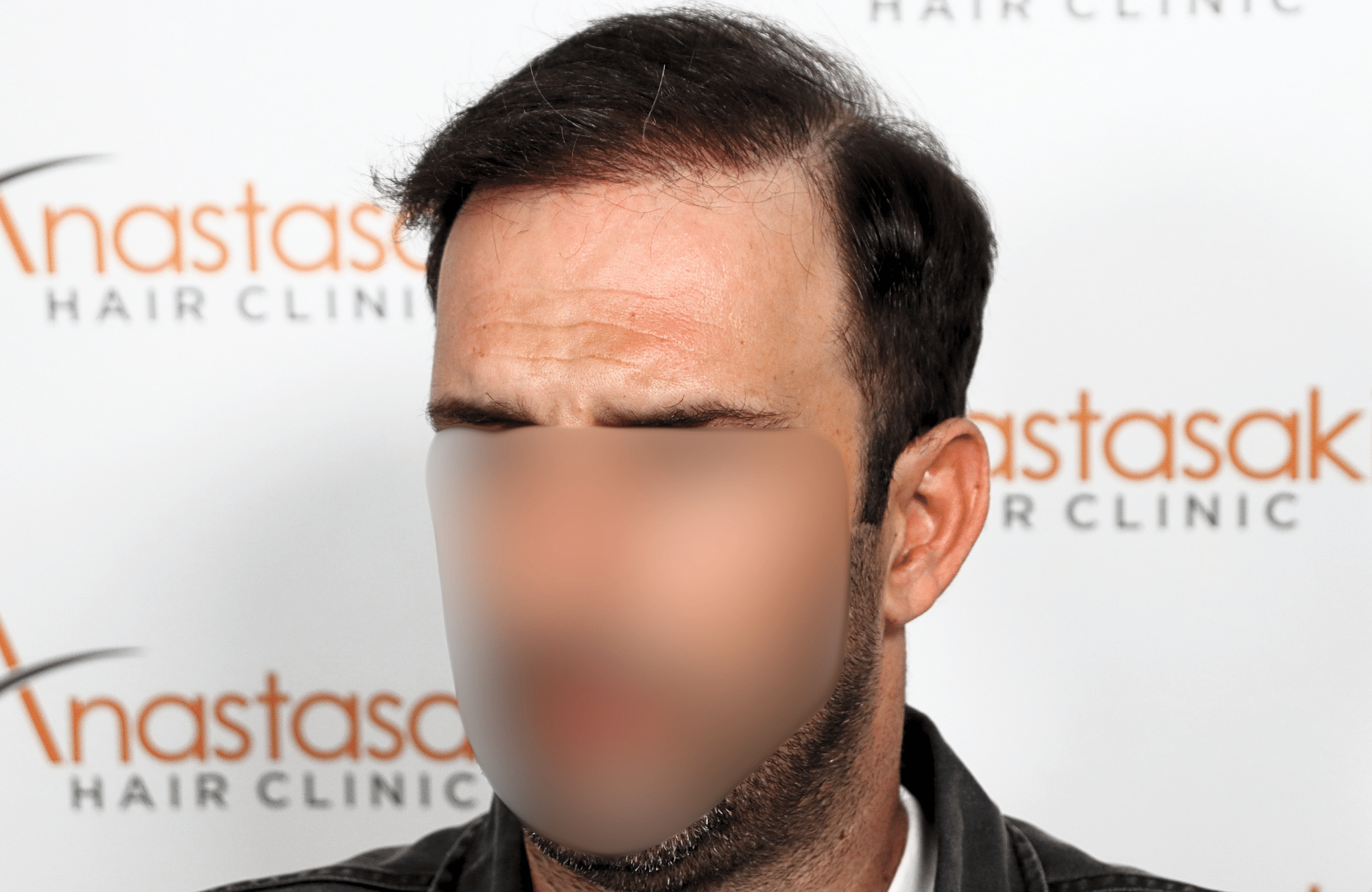 hair transplant 2600 fus thin 1st stage