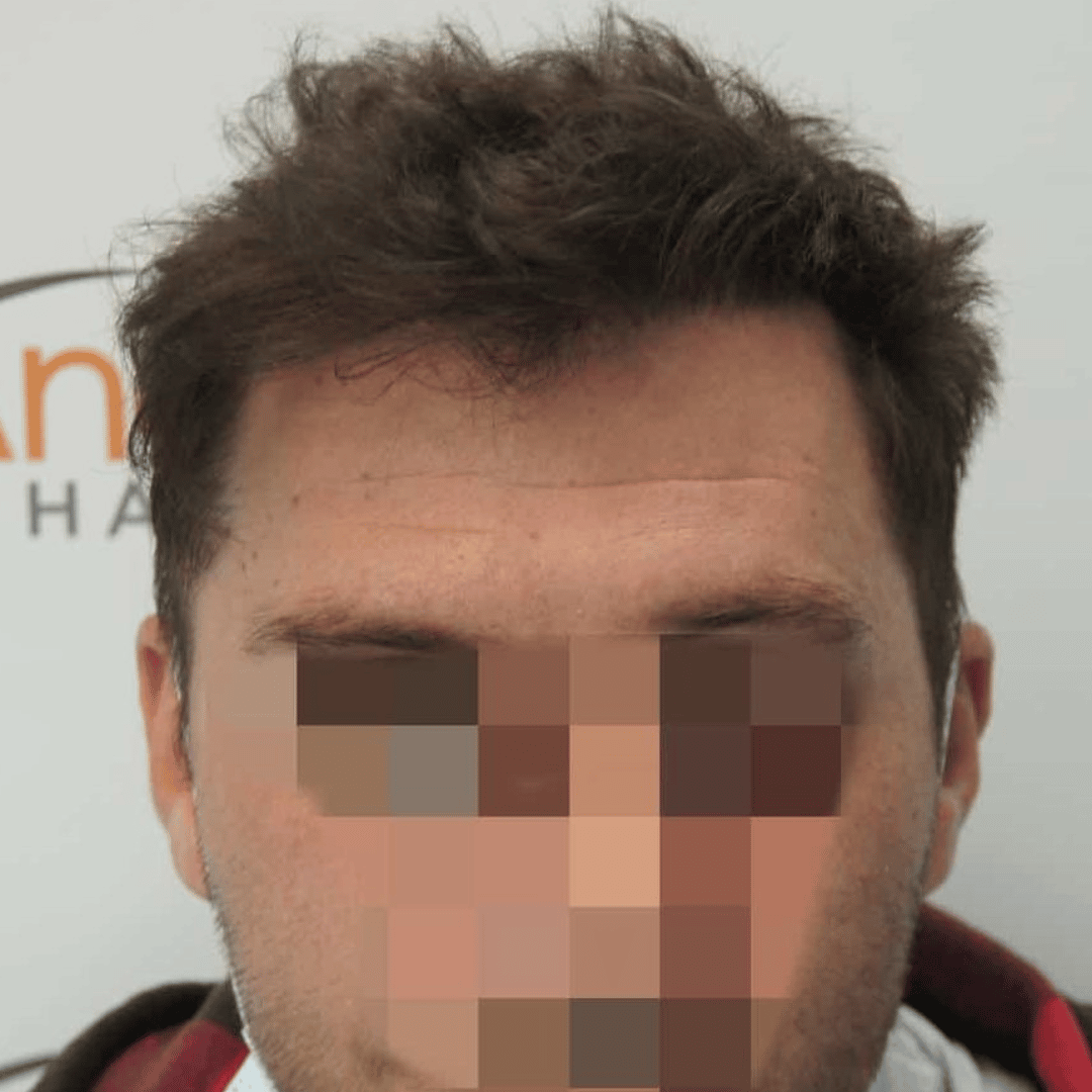 περιστατικο μετα τη μεταμοσχευση μαλλιων του στην anastasakis hair clinic