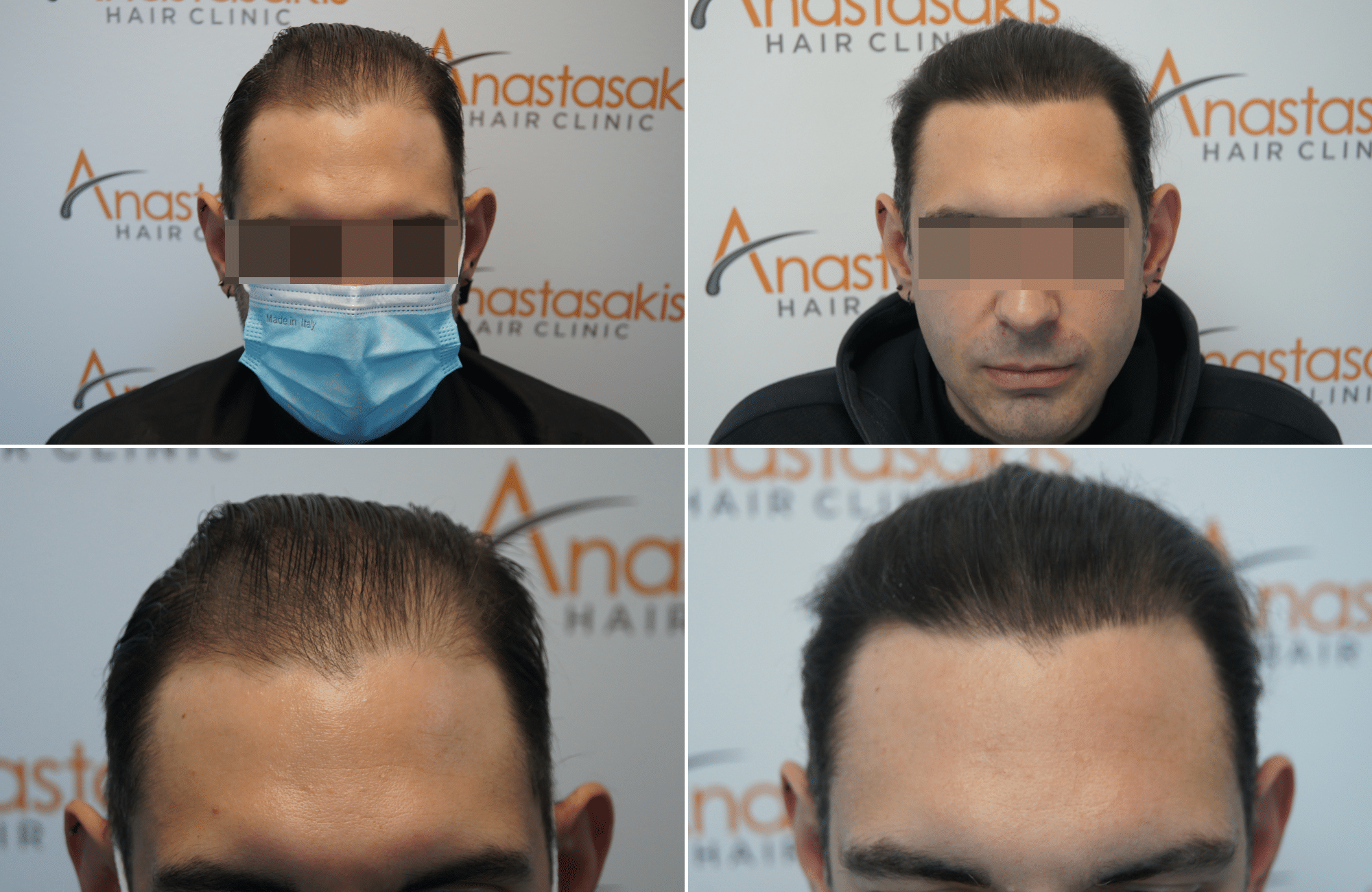 https://www.anastasakishairclinic.gr/portfolio/1500-fus-apotelesma-anastasakis-hair-clinic-fue/