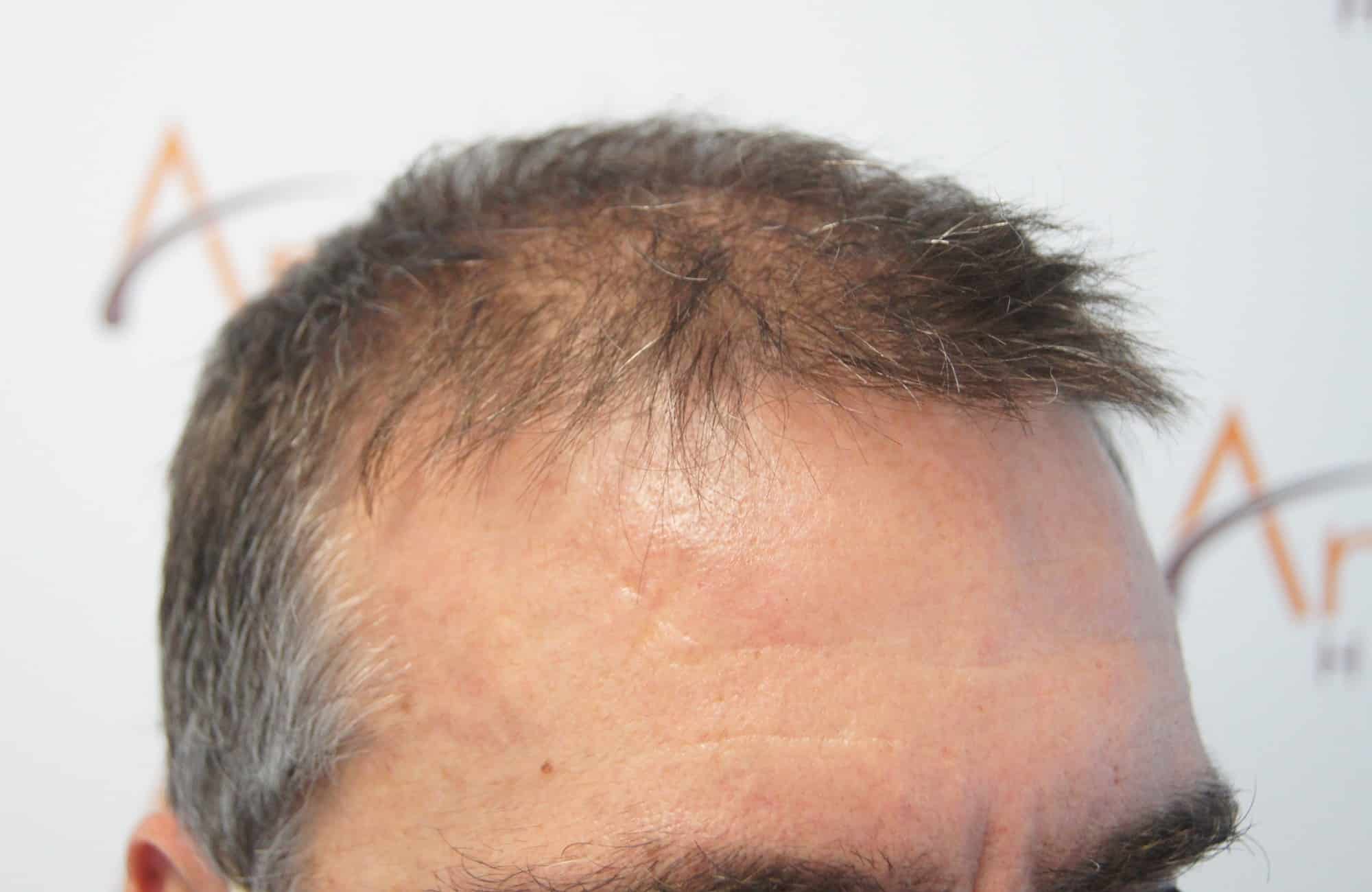 περιστατικο πριν τη μεταμόσχευση μαλλιων στην anastasakis hair clinic 6