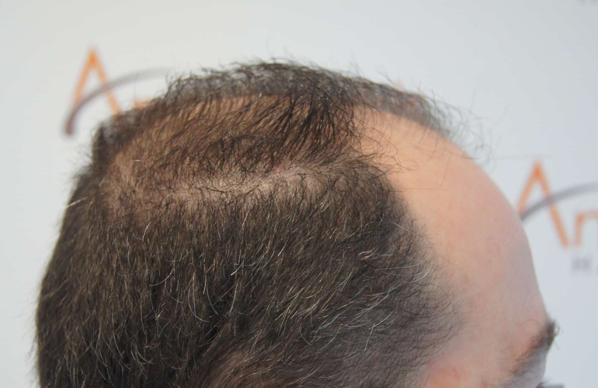 περιστατικο πριν τη μεταμόσχευση μαλλιων στην anastasakis hair clinic 6