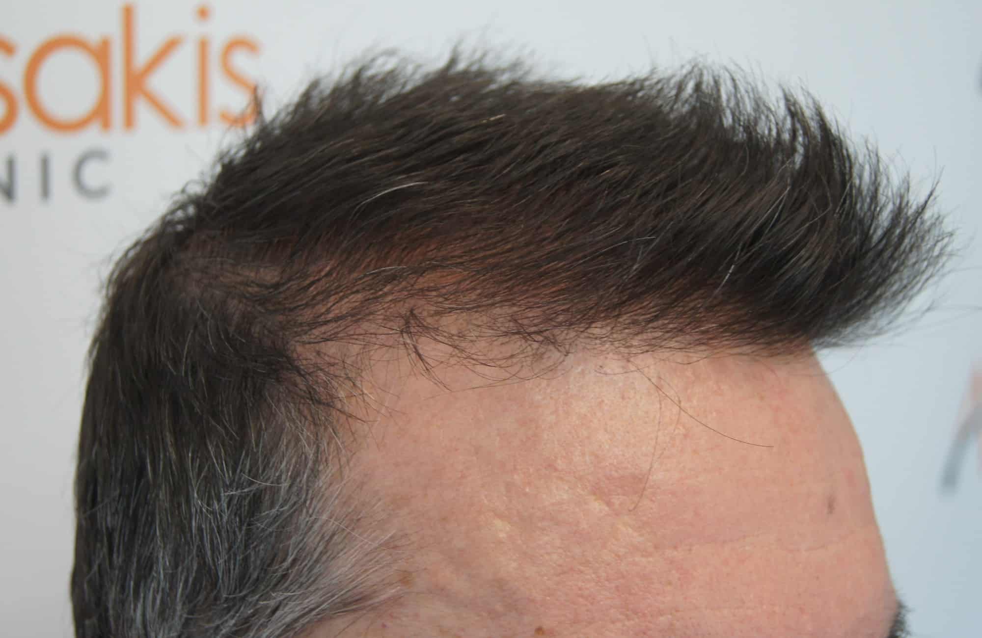 περιστατικο μετα τη μεταμόσχευση μαλλιων με 3200 fus στην anastasakis hair clinic 6