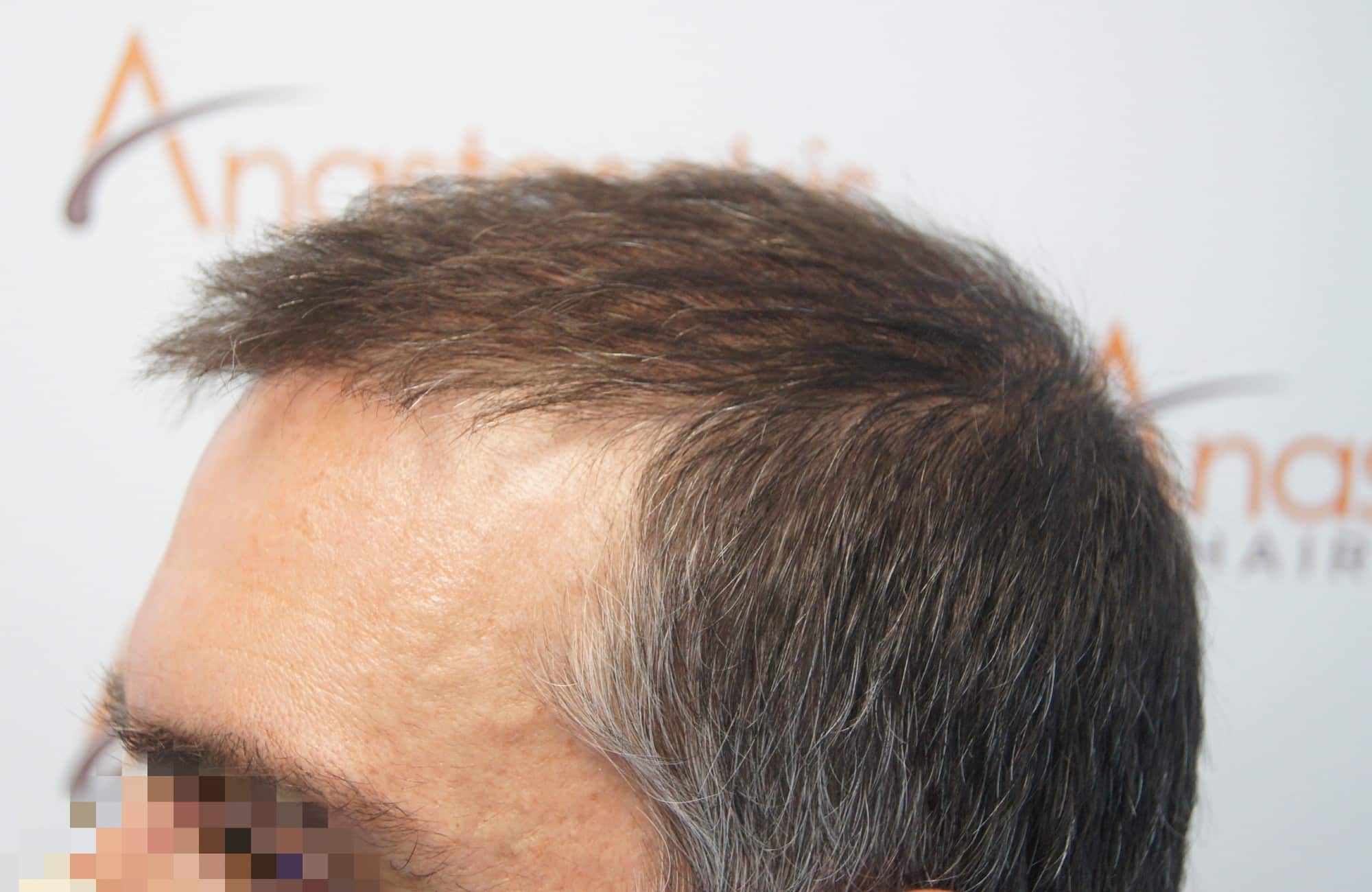 περιστατικο πριν τη μεταμόσχευση μαλλιων στην anastasakis hair clinic 7