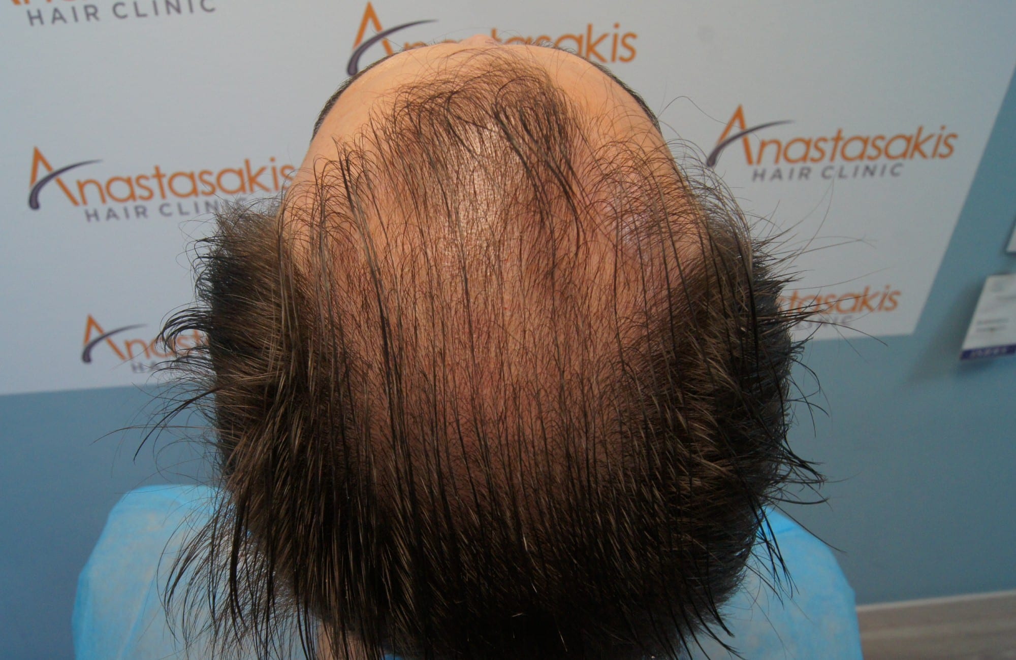 περιστατικο πριν τη μεταμόσχευση μαλλιων στην anastasakis hair clinic 7