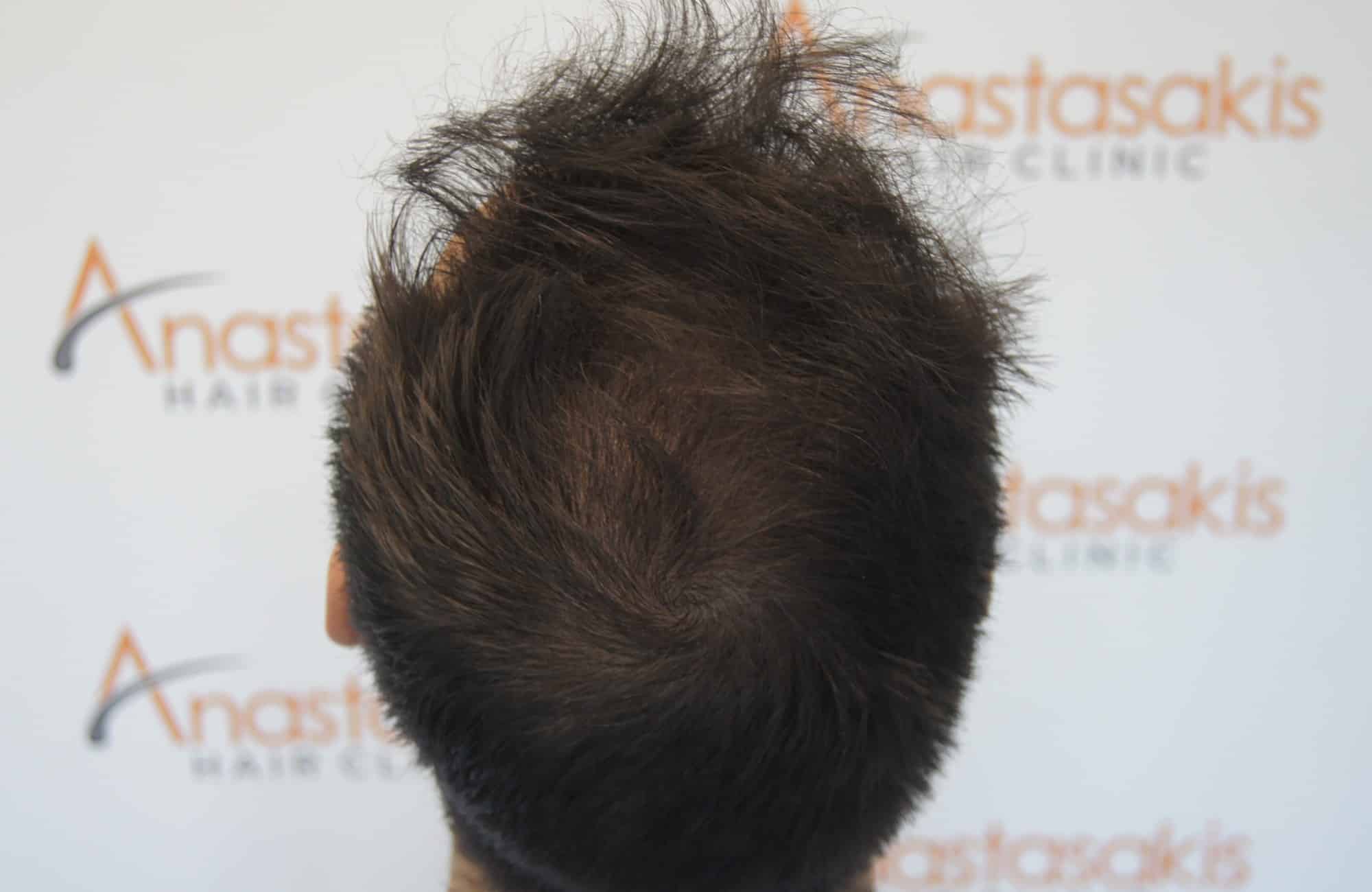 περιστατικο μετα τη μεταμόσχευση μαλλιων με 2250 fus στην anastasakis hair clinic 7