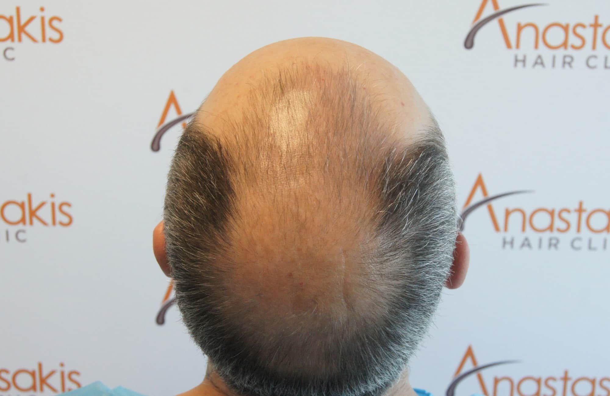 περιστατικο πριν τη μεταμόσχευση μαλλιων στην anastasakis hair clinic 8
