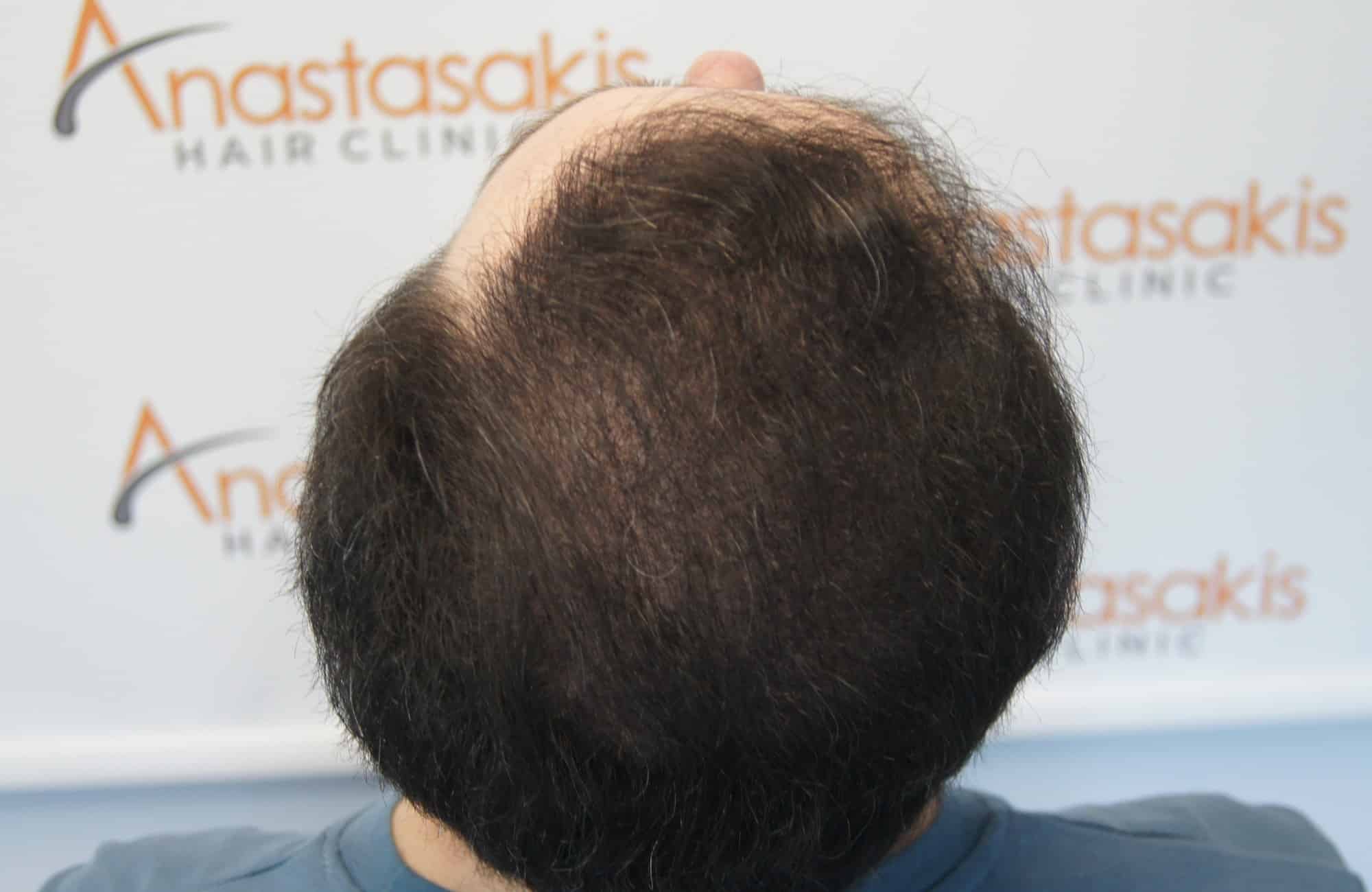 περιστατικο μετα τη μεταμόσχευση μαλλιων με 3600 fus στην anastasakis hair clinic 8
