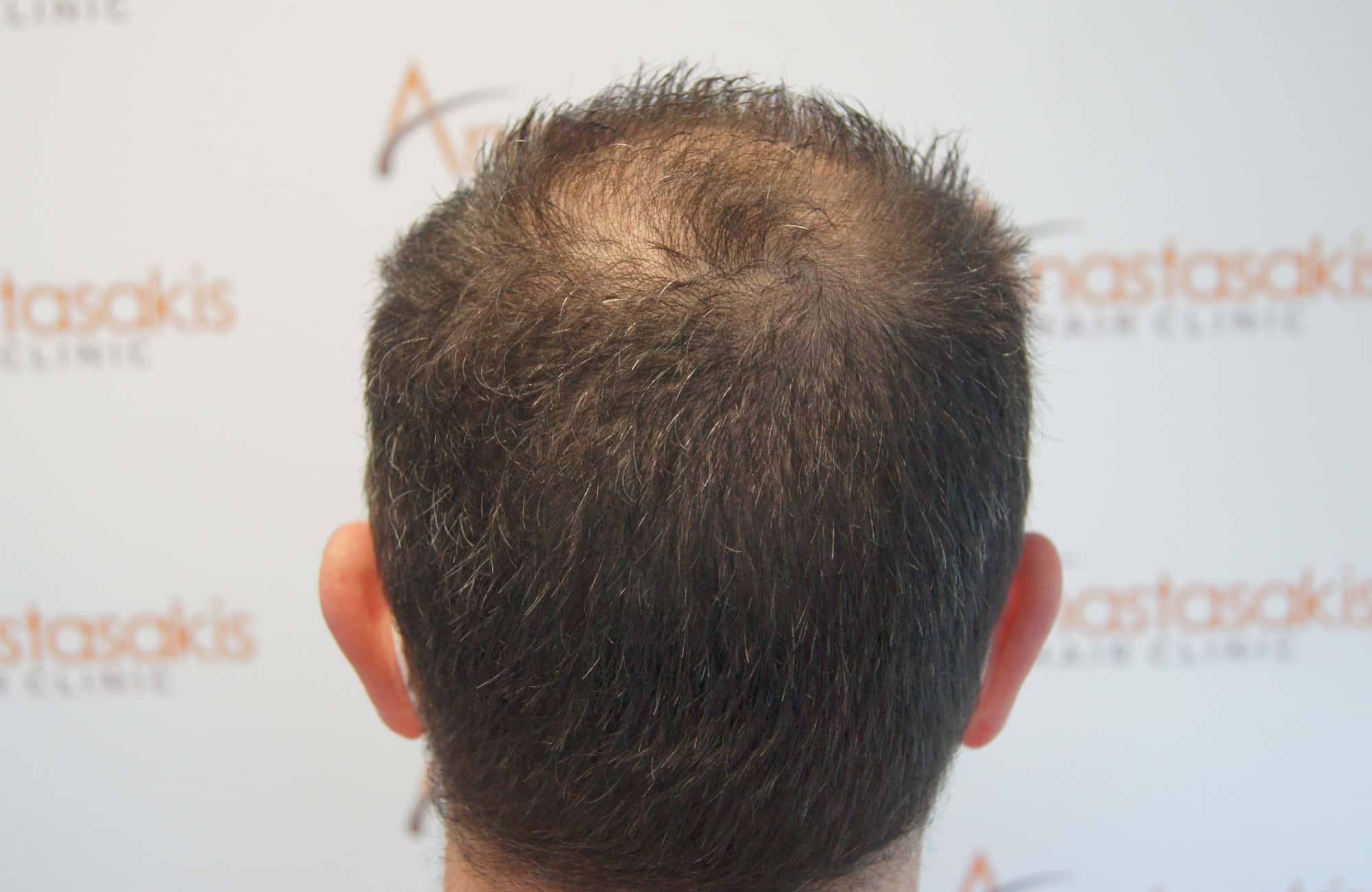 περιστατικο πριν τη μεταμόσχευση μαλλιων στην anastasakis hair clinic 9