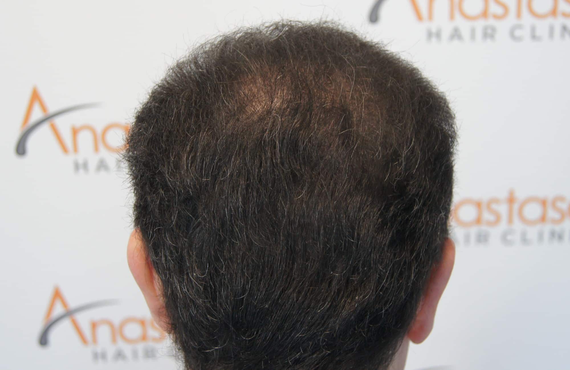 περιστατικο μετα τη μεταμόσχευση μαλλιων με 3600 fus στην anastasakis hair clinic 9