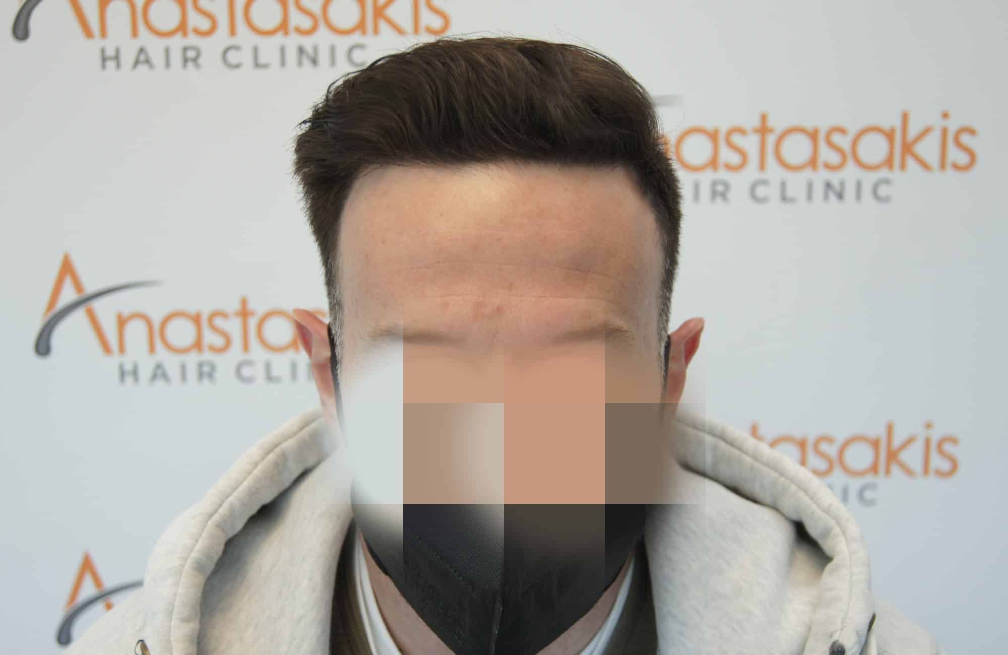 περιστατικο μετα τη μεταμόσχευση μαλλιων με 2000 fus στην anastasakis hair clinic