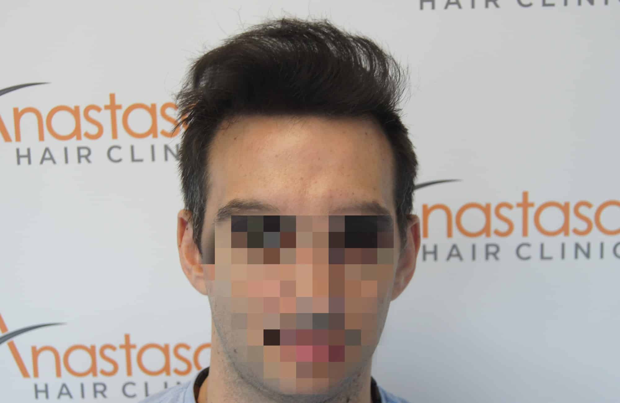 περιστατικο μετα τη μεταμόσχευση μαλλιων με 2250 fus στην anastasakis hair clinic