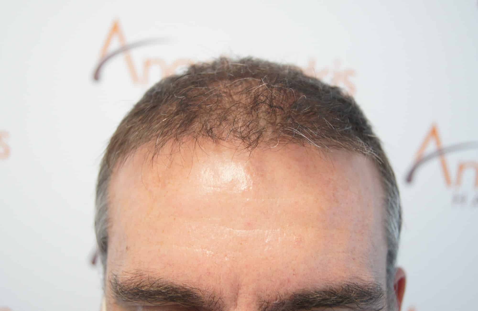 περιστατικο πριν τη μεταμόσχευση μαλλιων στην anastasakis hair clinic 2