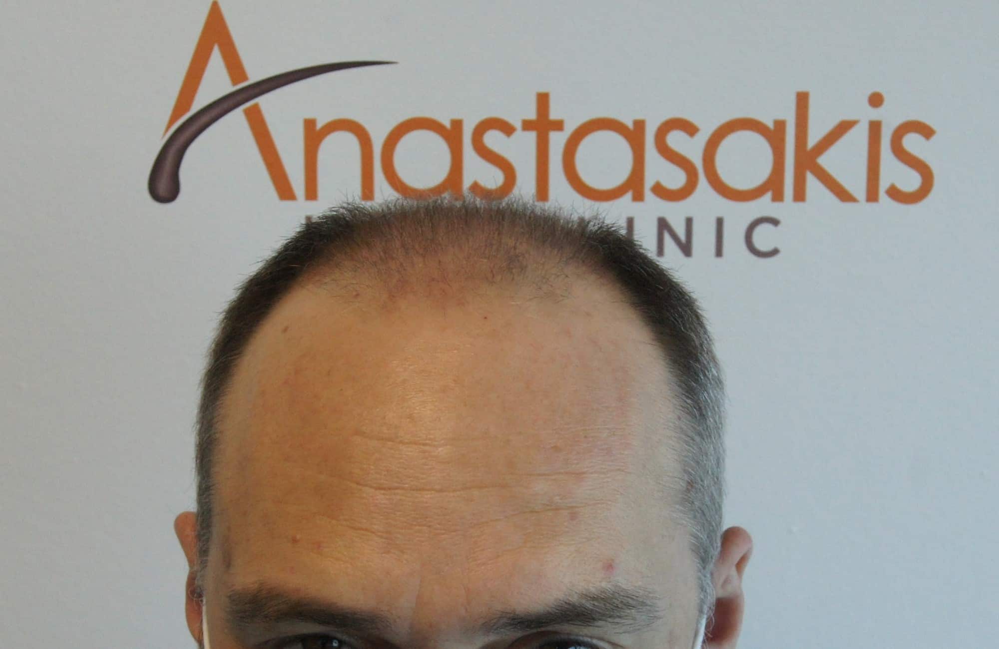 περιστατικο πριν τη μεταμόσχευση μαλλιων στην anastasakis hair clinic 2
