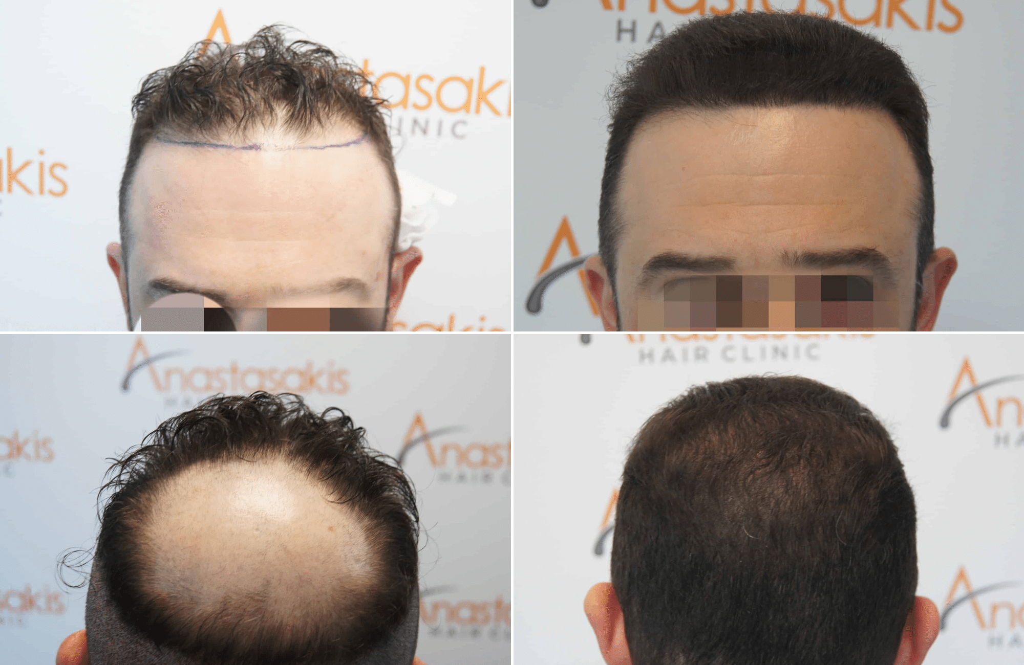 https://www.anastasakishairclinic.gr/portfolio/apotelesma-metamosxefsis-mallion-anastasakis-hair-clinic-300/