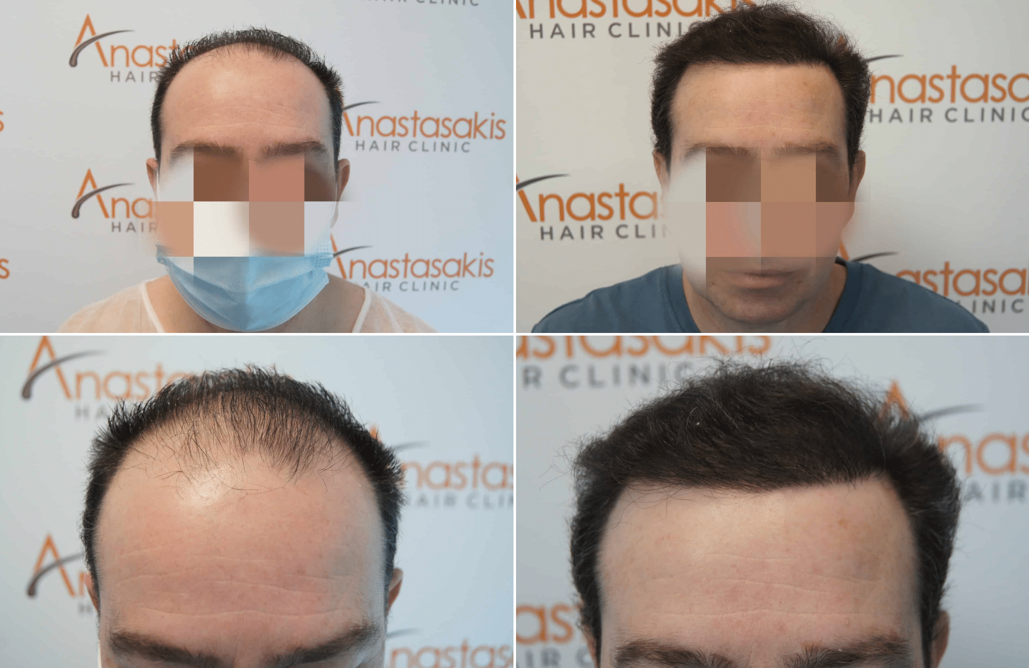 https://www.anastasakishairclinic.gr/portfolio/apotelesma-metamosxefsis-mallion-anastasakis-hair-clinic-301/