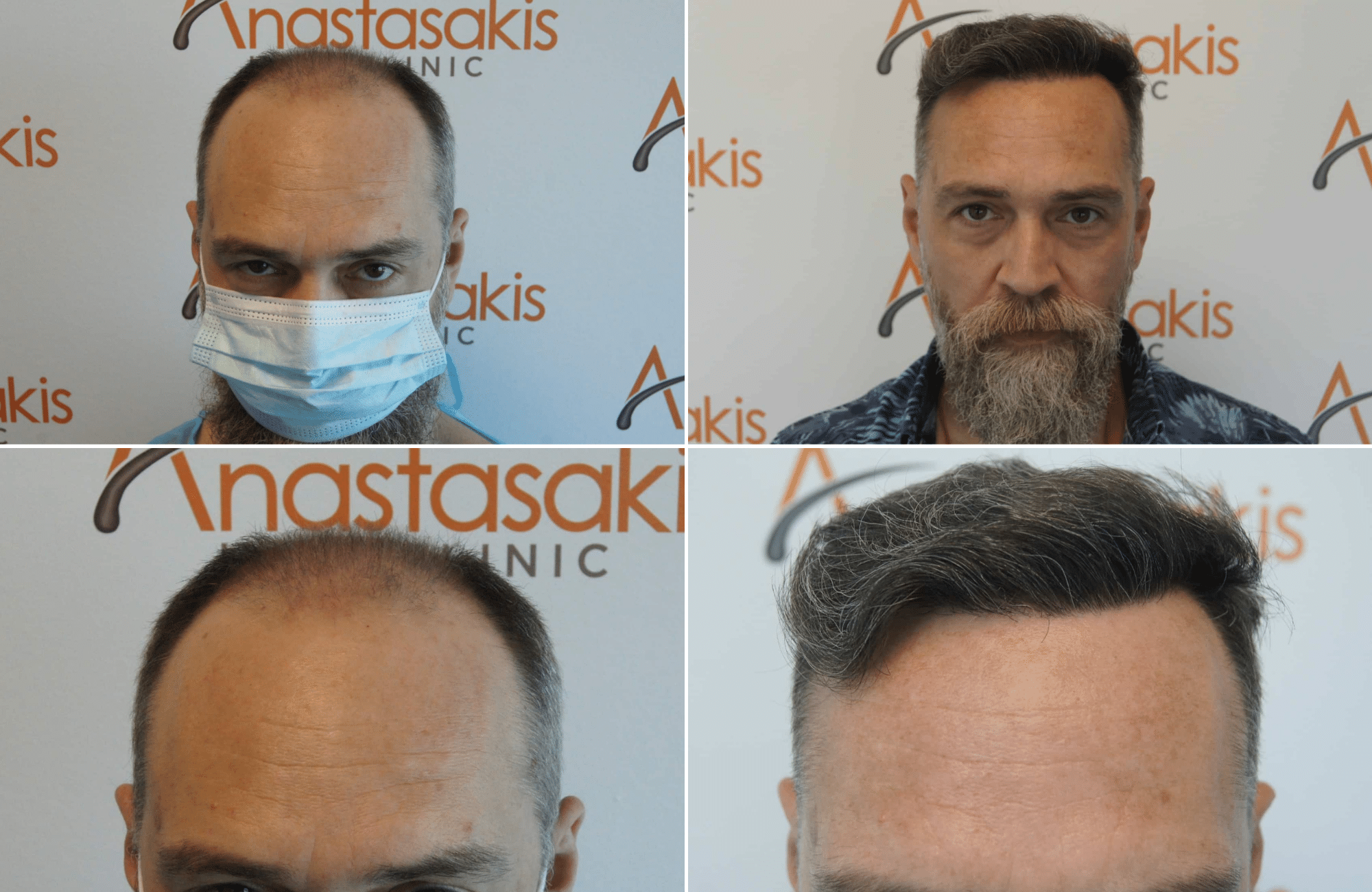 https://www.anastasakishairclinic.gr/portfolio/apotelesma-metamosxefsis-mallion-anastasakis-hair-clinic-303/