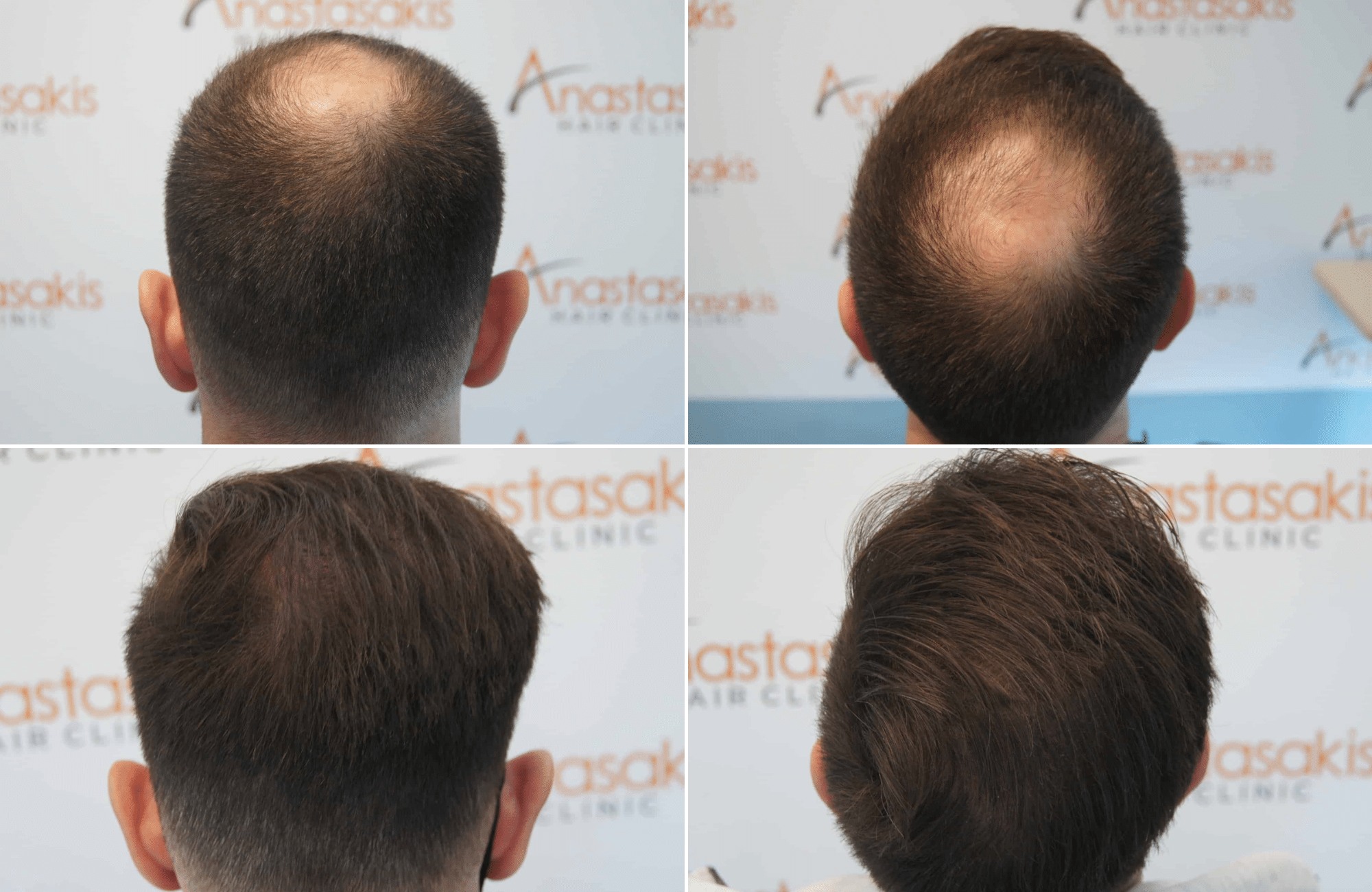 https://www.anastasakishairclinic.gr/portfolio/apotelesma-metamosxefsis-mallion-anastasakis-hair-clinic-304/