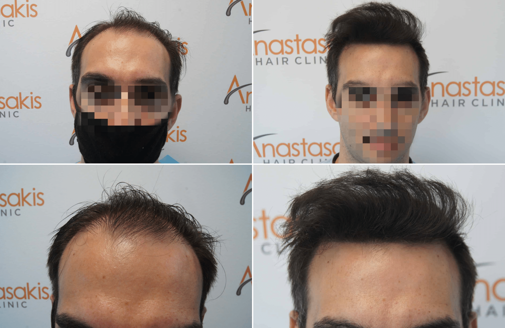 https://www.anastasakishairclinic.gr/portfolio/apotelesma-metamosxefsis-mallion-anastasakis-hair-clinic-305/