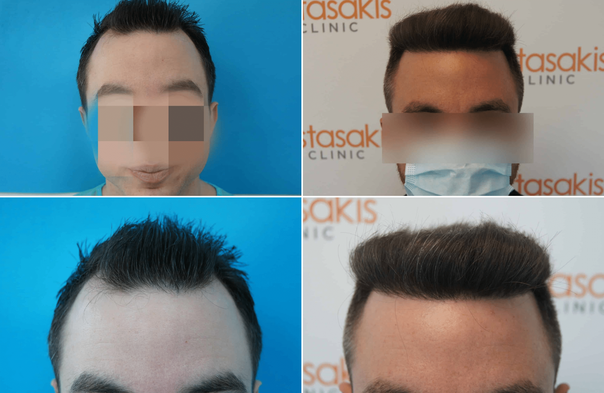 https://www.anastasakishairclinic.gr/portfolio/apotelesma-metamosxefsis-mallion-anastasakis-hair-clinic-308/