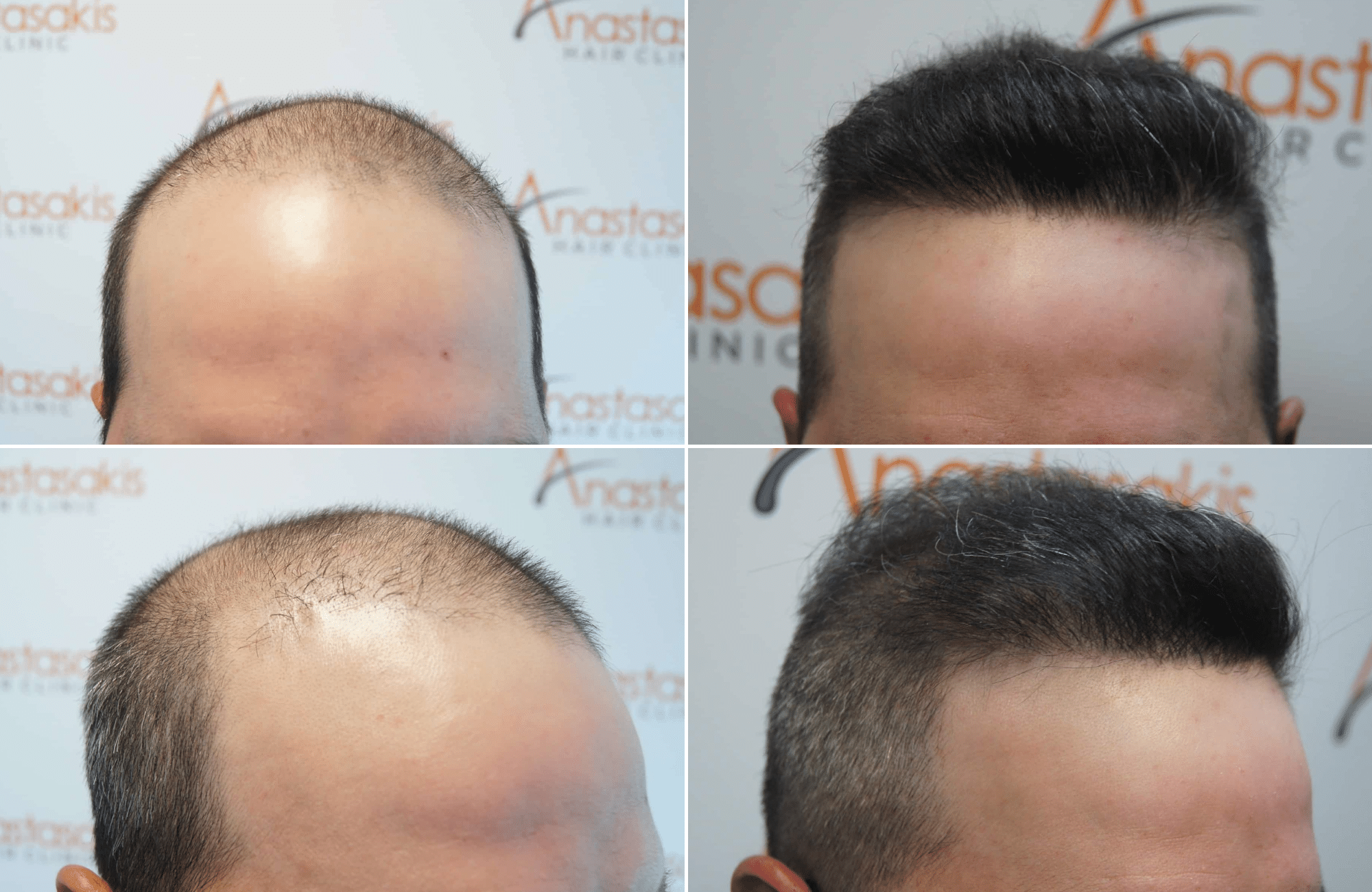 https://www.anastasakishairclinic.gr/portfolio/apotelesma-metamosxefsis-mallion-anastasakis-hair-clinic-329/