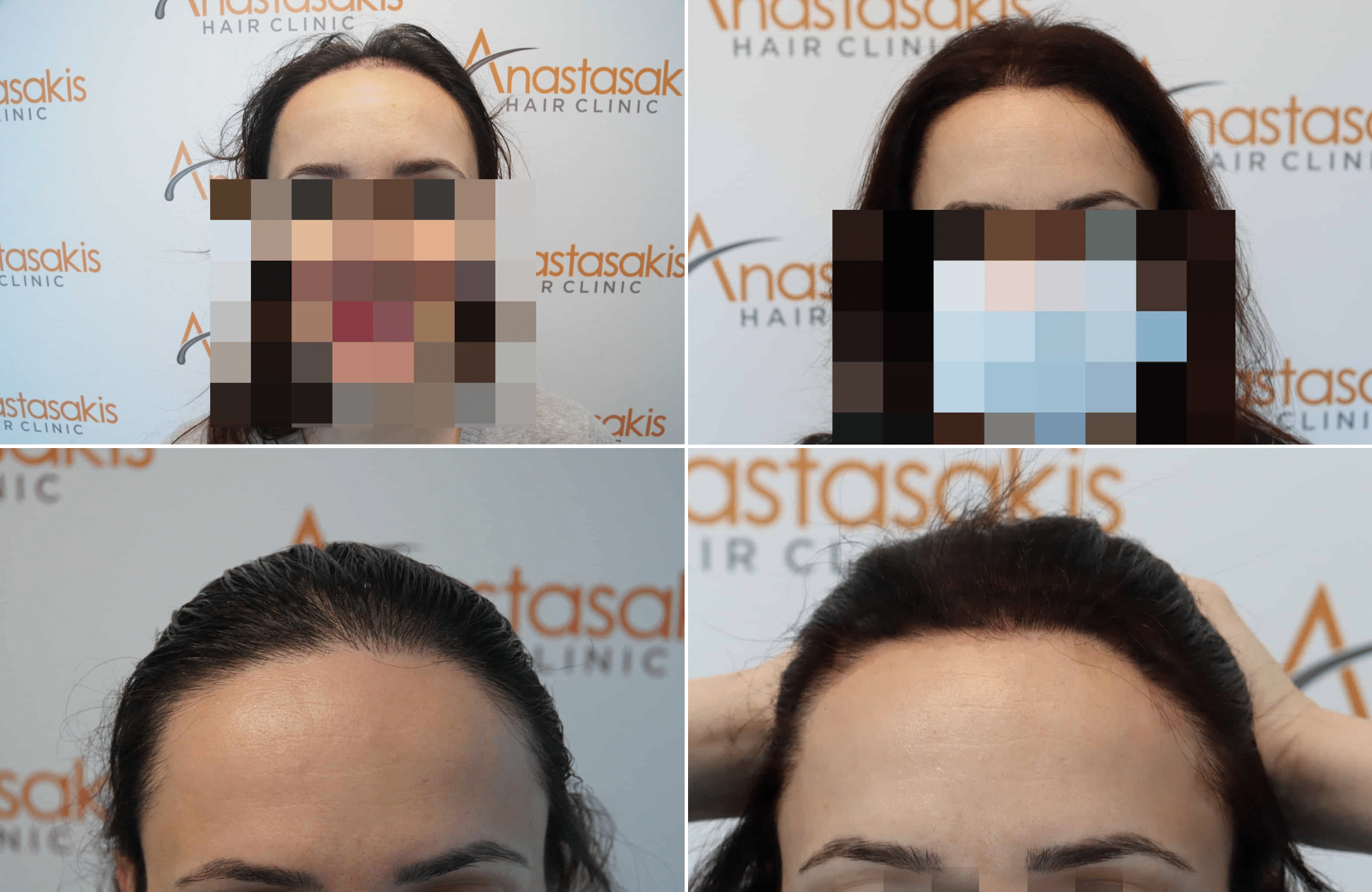https://www.anastasakishairclinic.gr/portfolio/apotelesma-metamosxefsis-mallion-anastasakis-hair-clinic-335/