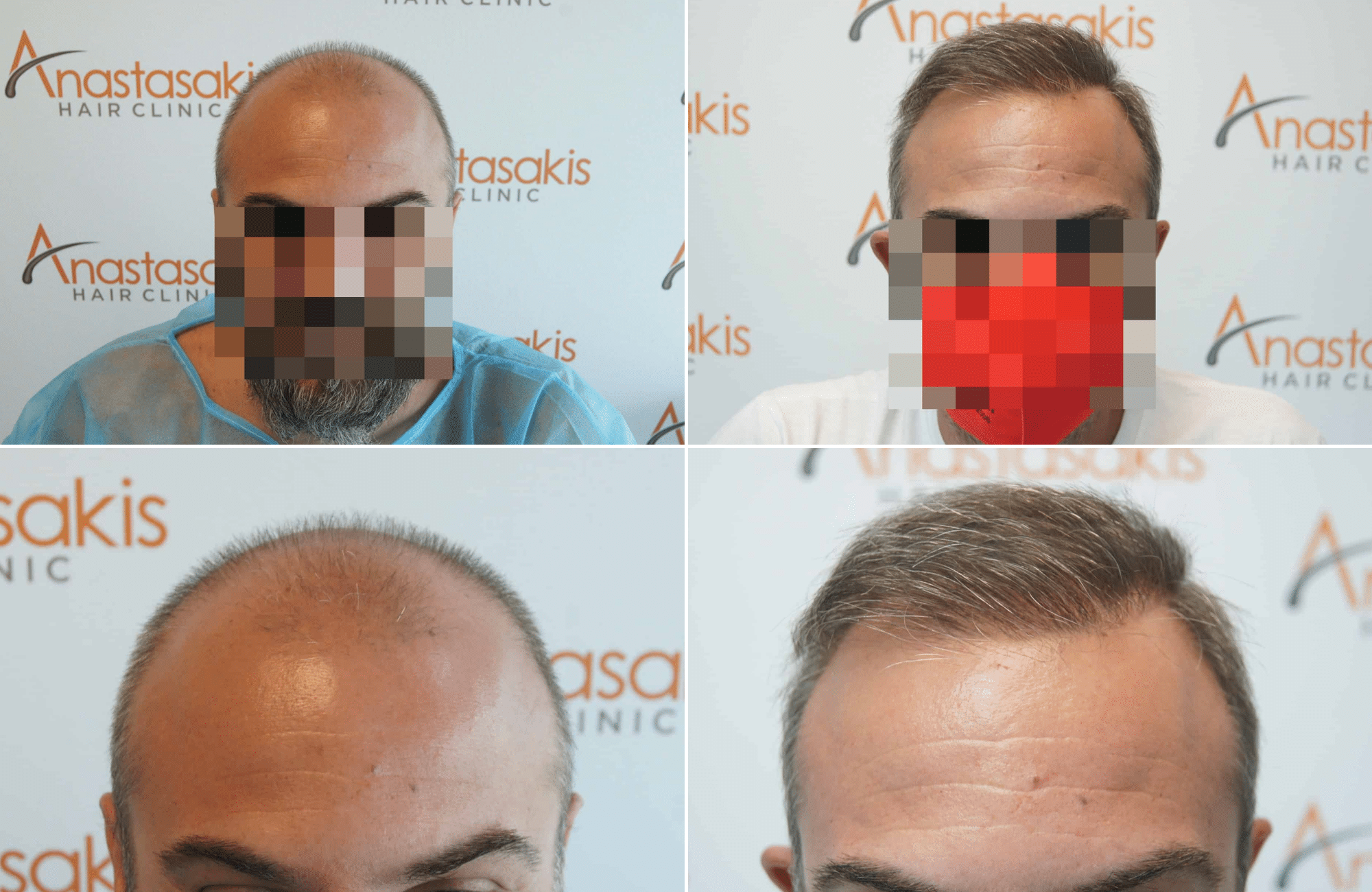https://www.anastasakishairclinic.gr/portfolio/apotelesma-metamosxefsis-mallion-anastasakis-hair-clinic-337/
