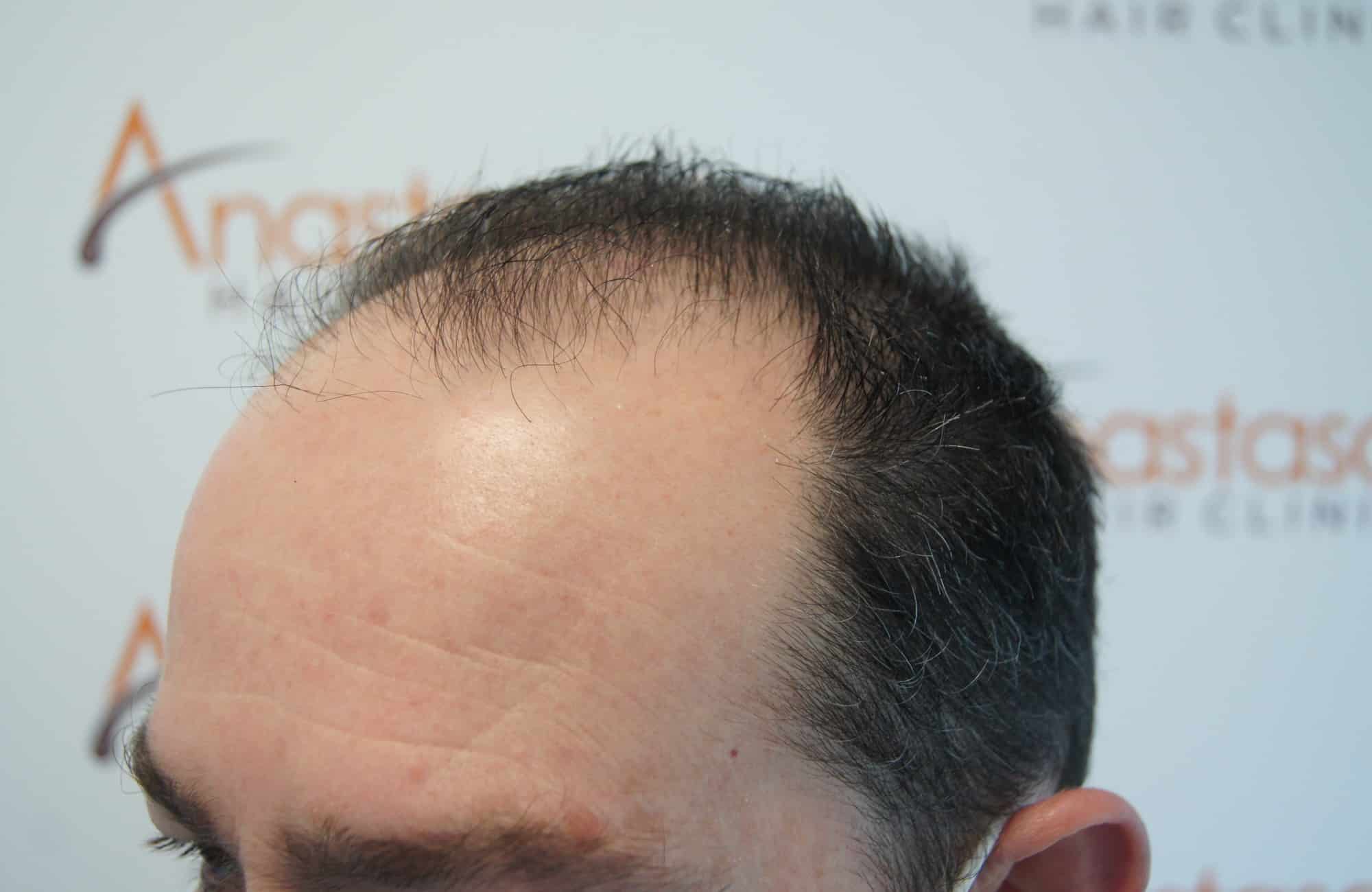 περιστατικο πριν τη μεταμόσχευση μαλλιων στην anastasakis hair clinic 3