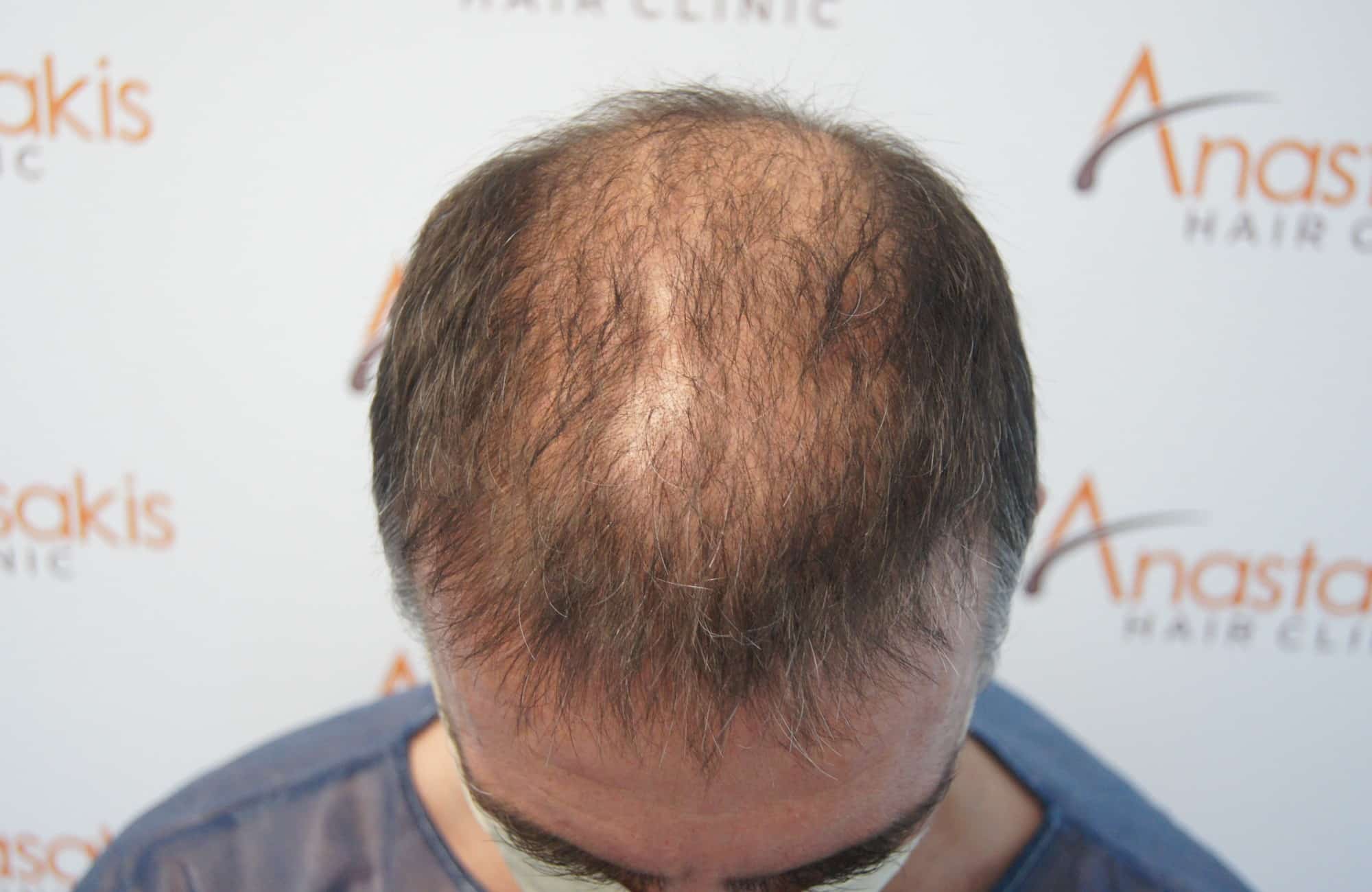περιστατικο πριν τη μεταμόσχευση μαλλιων στην anastasakis hair clinic 3