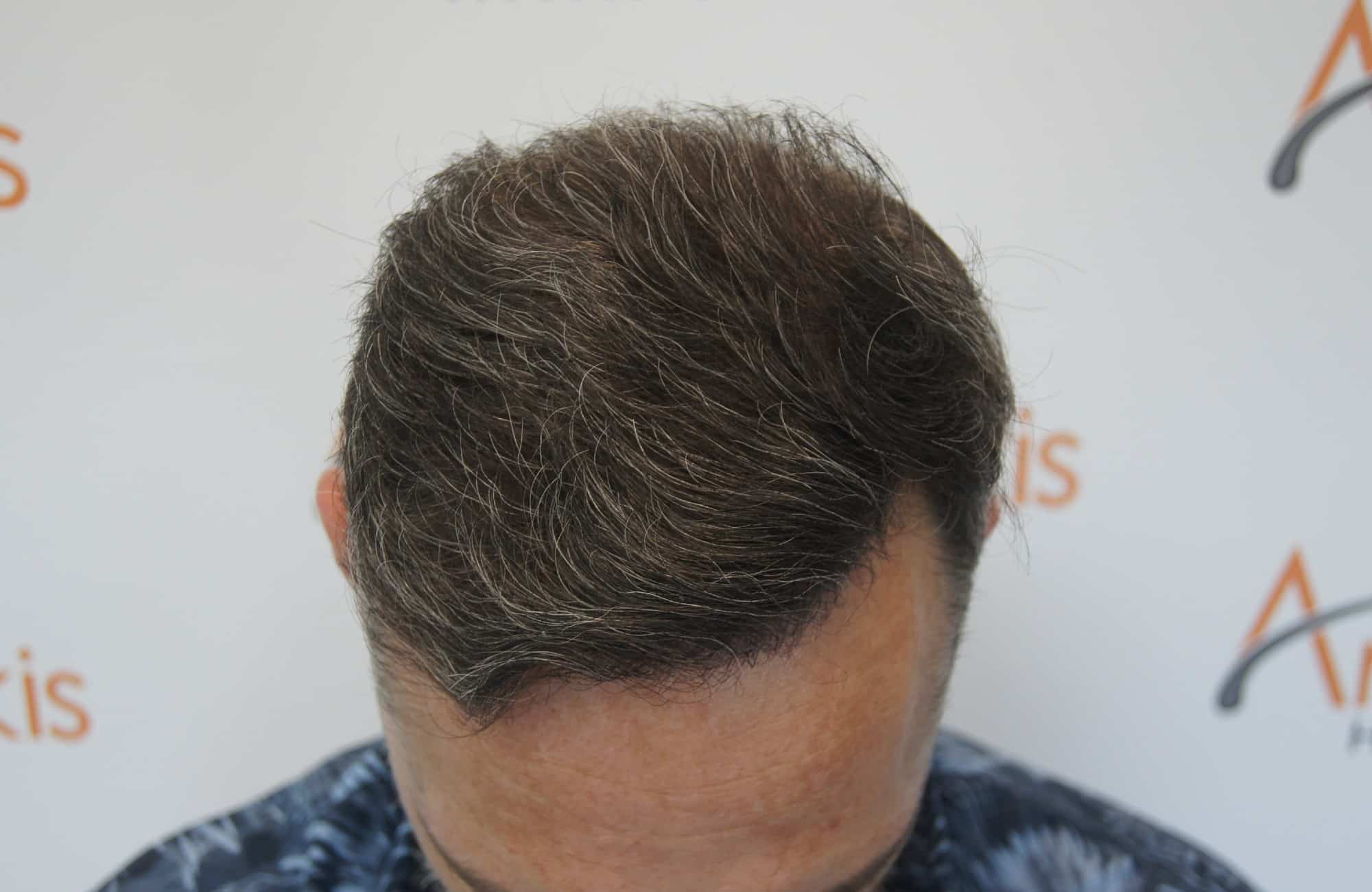 περιστατικο μετα τη μεταμόσχευση μαλλιων με 3200 fus στην anastasakis hair clinic 3