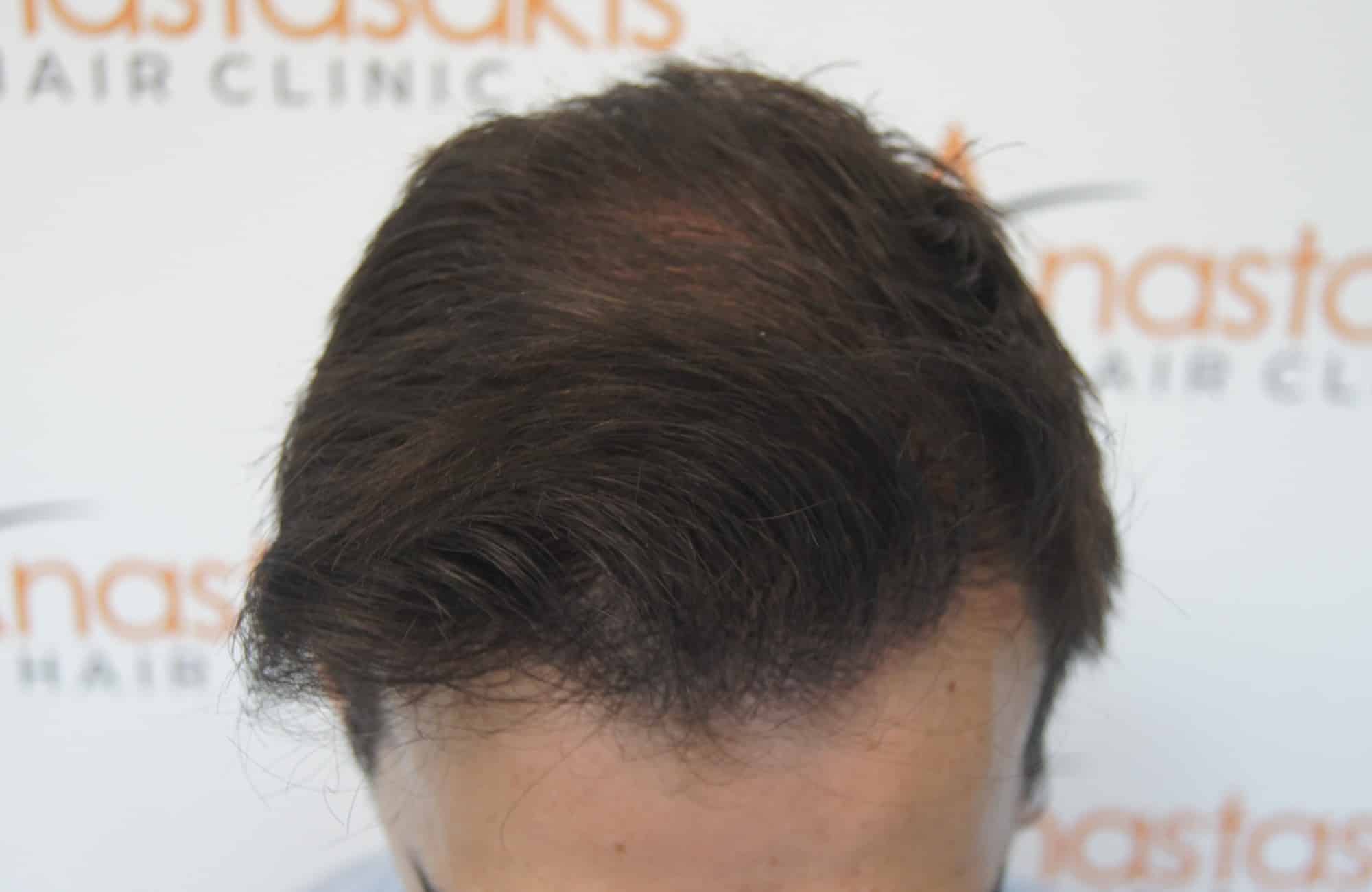 περιστατικο μετα τη μεταμόσχευση μαλλιων με 2250 fus στην anastasakis hair clinic 3