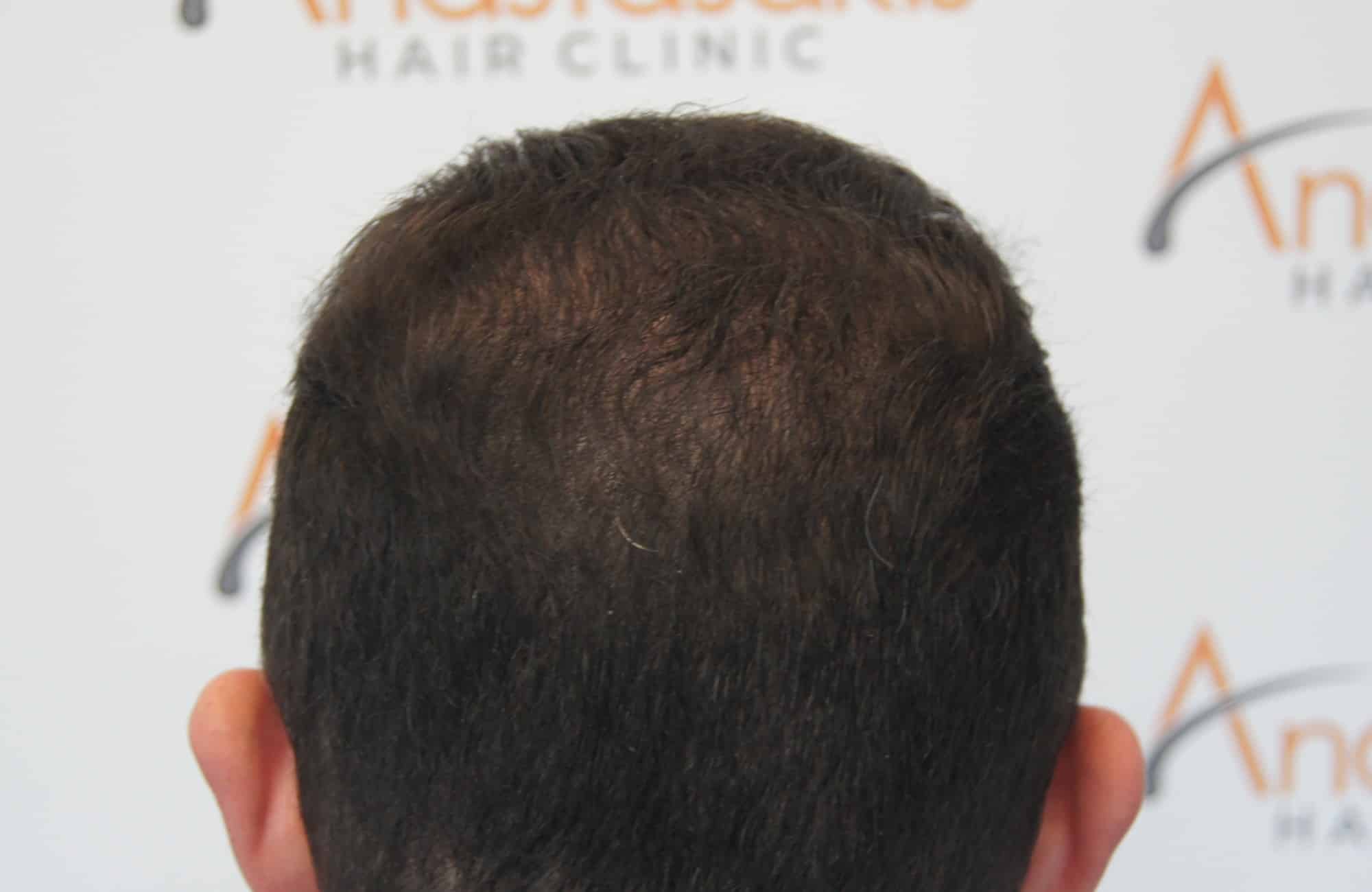 περιστατικο μετα τη μεταμόσχευση μαλλιων με 3000 fus στην anastasakis hair clinic 3