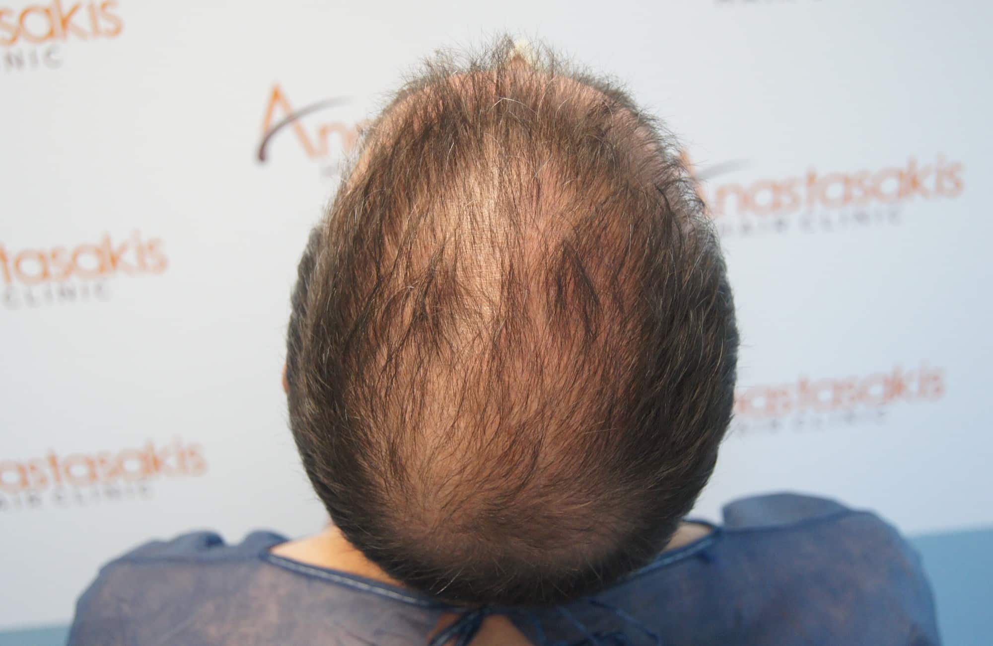 περιστατικο πριν τη μεταμόσχευση μαλλιων στην anastasakis hair clinic 4
