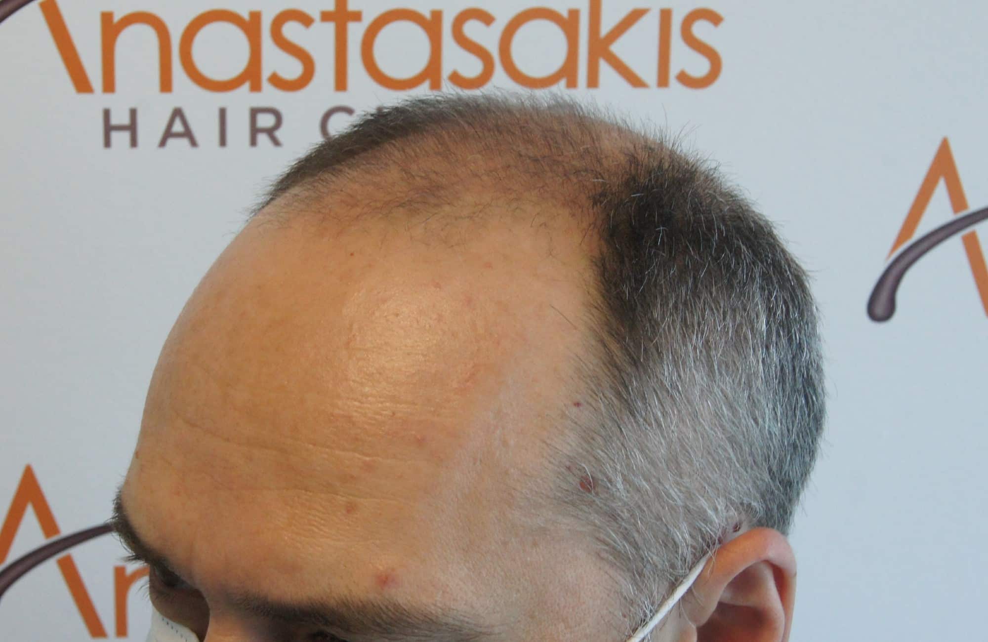περιστατικο πριν τη μεταμόσχευση μαλλιων στην anastasakis hair clinic 4