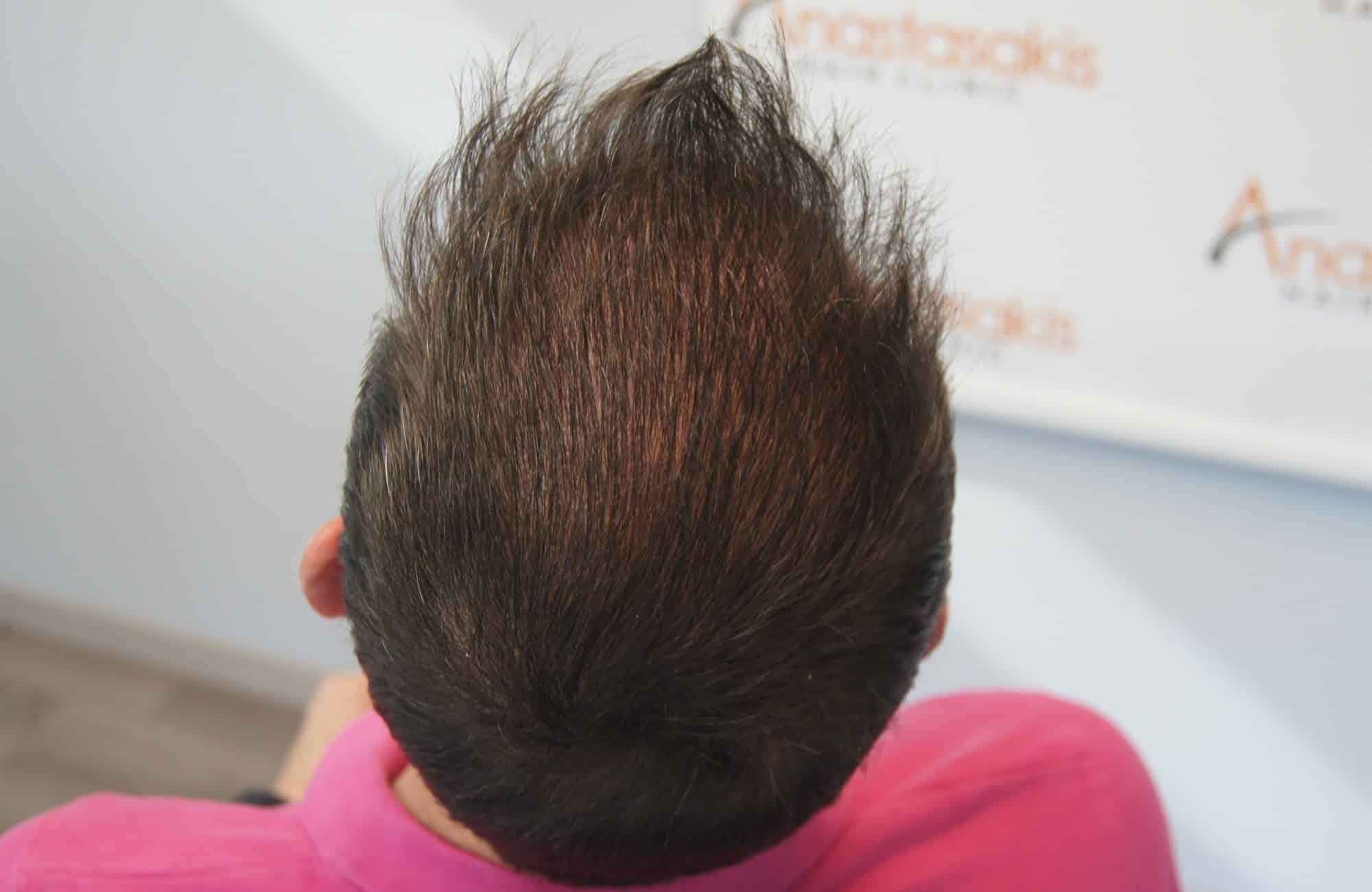 περιστατικο μετα τη μεταμόσχευση μαλλιων με 3200 fus στην anastasakis hair clinic 4