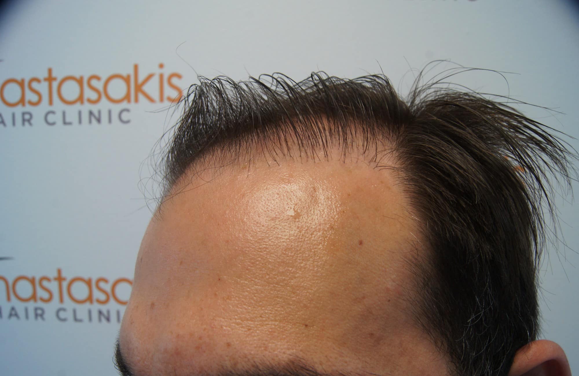 περιστατικο πριν τη μεταμόσχευση μαλλιων στην anastasakis hair clinic 5