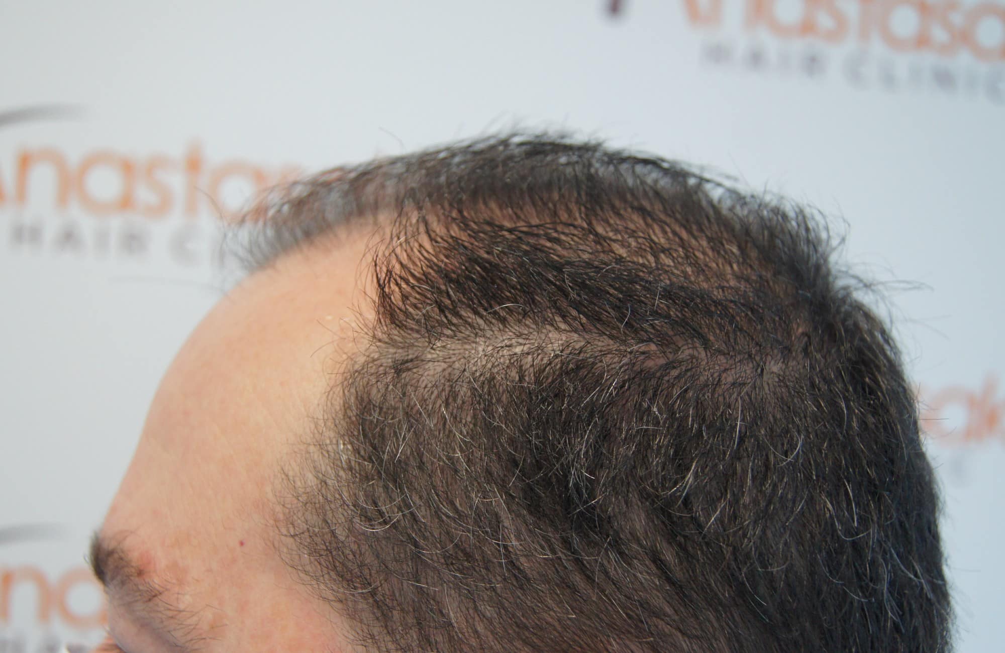 περιστατικο πριν τη μεταμόσχευση μαλλιων στην anastasakis hair clinic 5