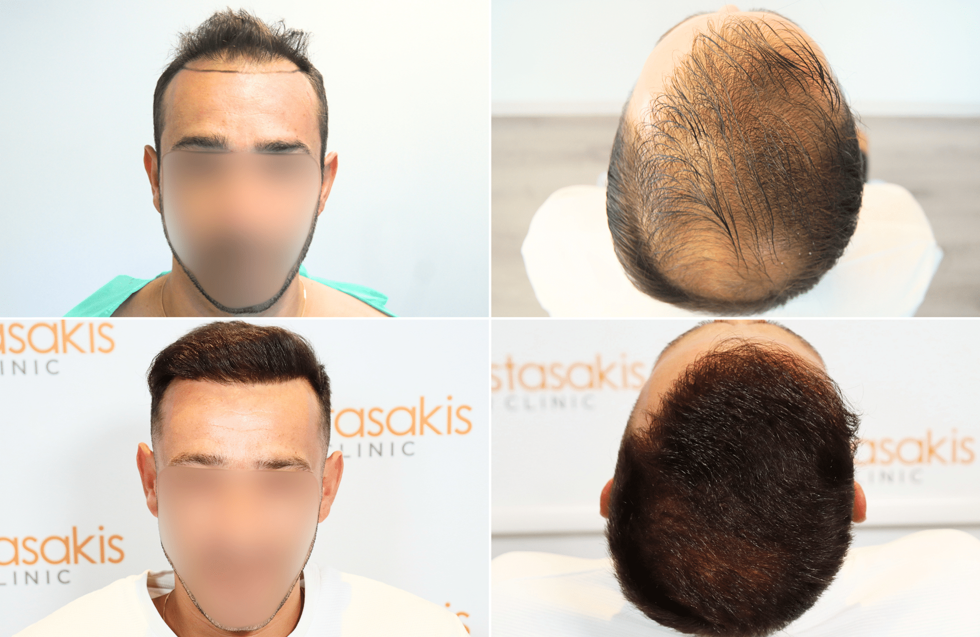https://www.anastasakishairclinic.gr/portfolio/apotelesma-metamosxefsis-mallion-anastasakis-hair-clinic-112/