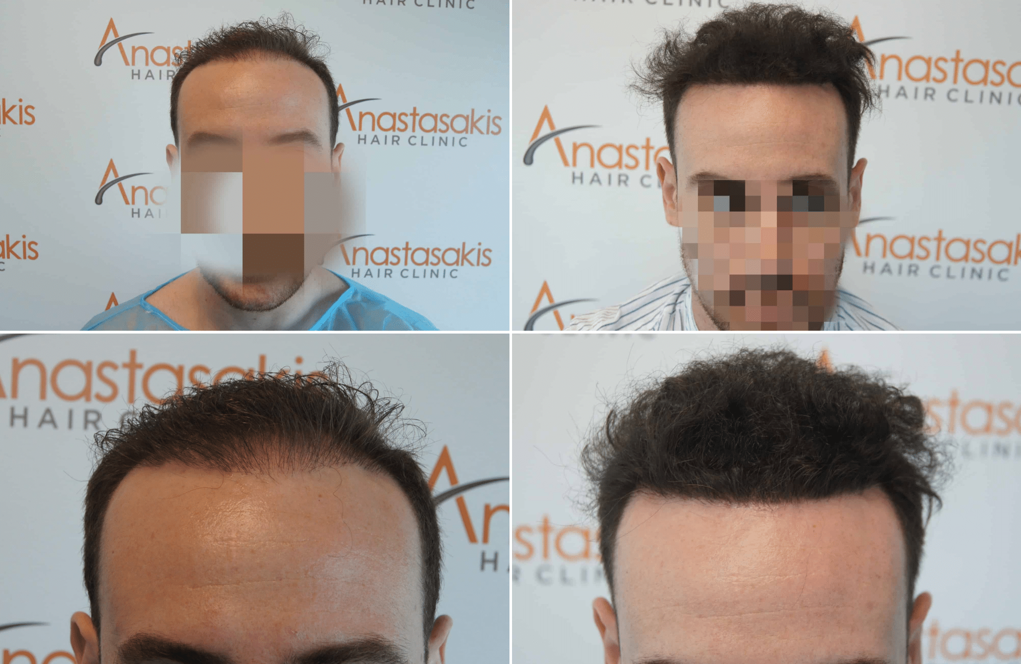 https://www.anastasakishairclinic.gr/portfolio/apotelesma-metamosxefsis-mallion-anastasakis-hair-clinic-306/