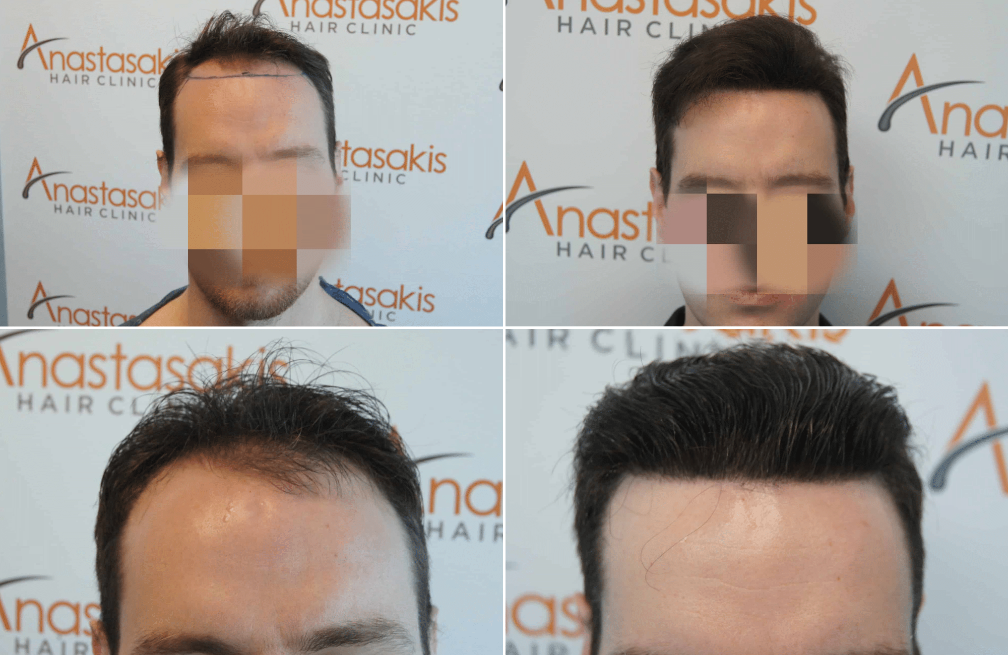 https://www.anastasakishairclinic.gr/portfolio/apotelesma-metamosxefsis-mallion-anastasakis-hair-clinic-307/