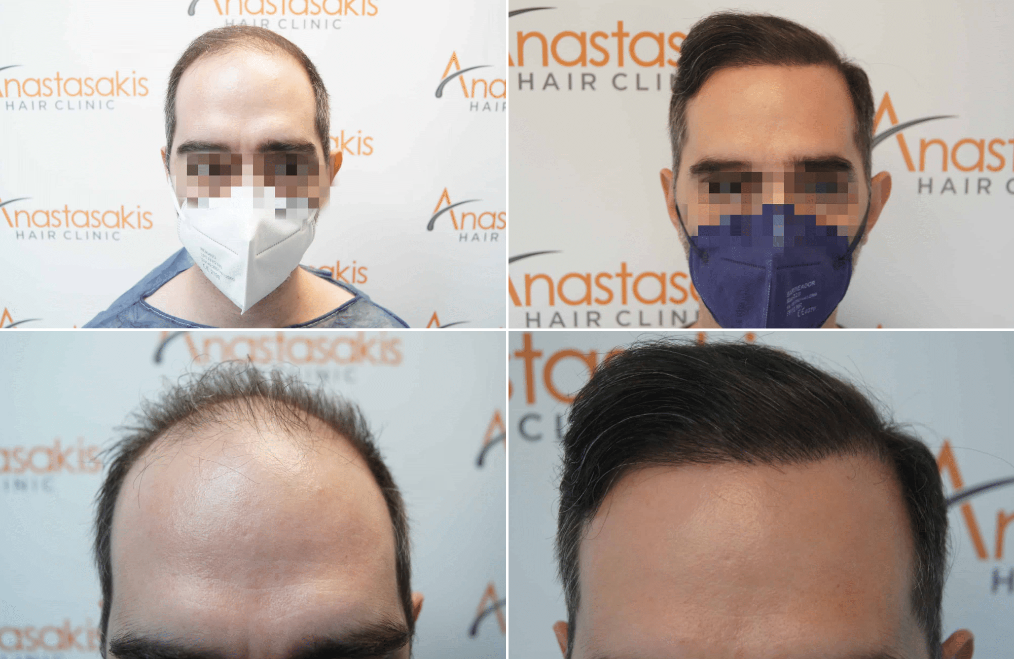 https://www.anastasakishairclinic.gr/portfolio/apotelesma-metamosxefsis-mallion-anastasakis-hair-clinic-309/