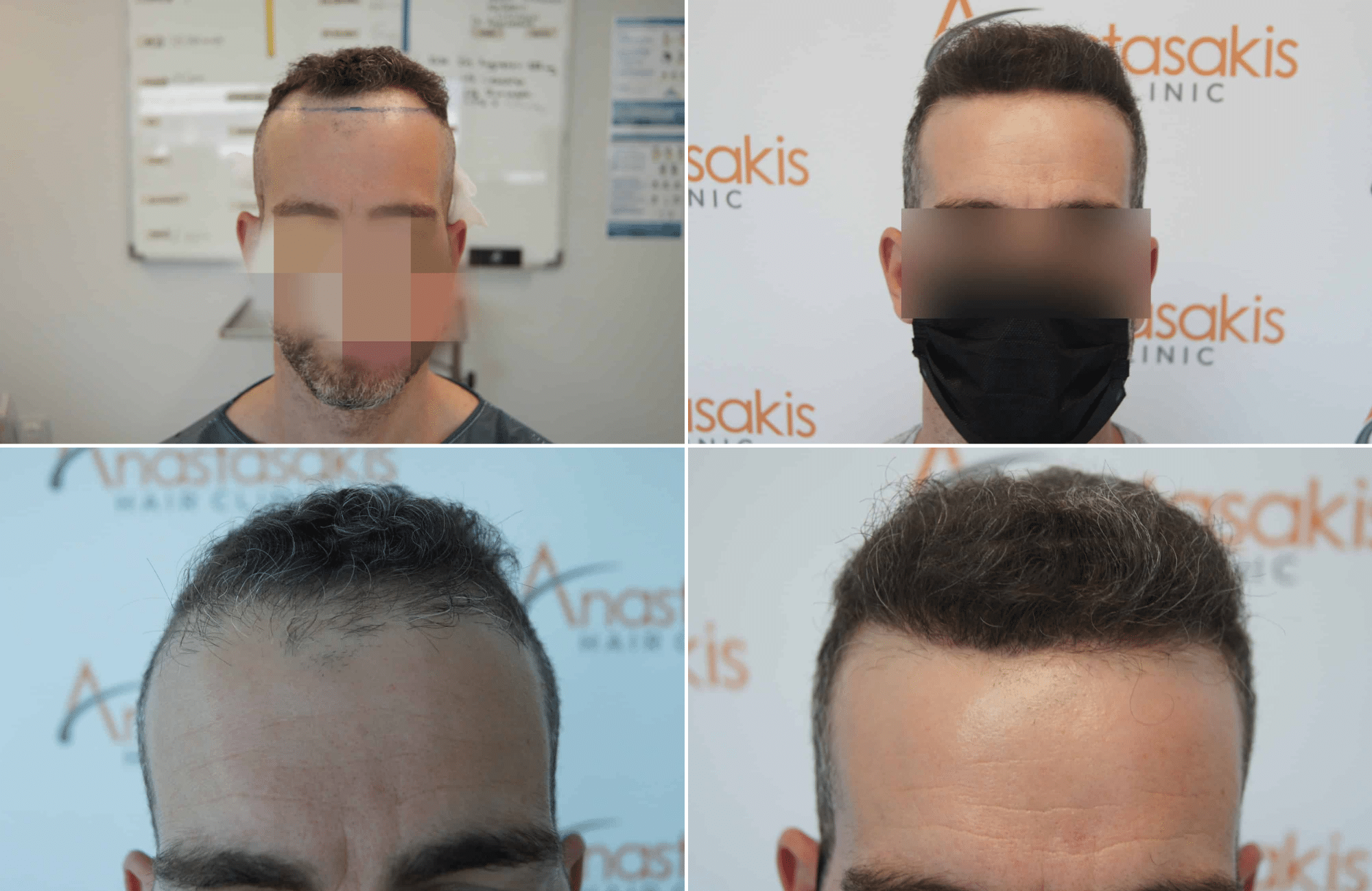 https://www.anastasakishairclinic.gr/portfolio/apotelesma-metamosxefsis-mallion-anastasakis-hair-clinic-310/