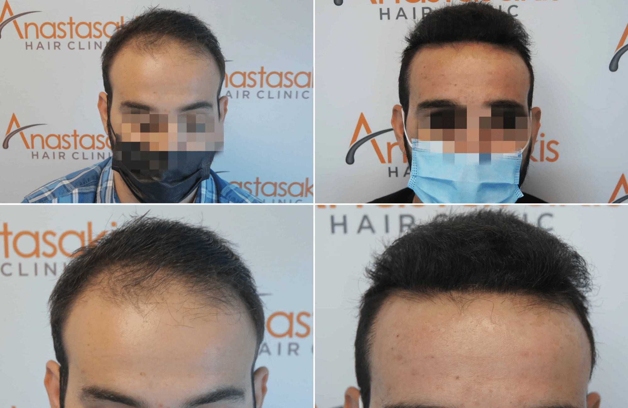 https://www.anastasakishairclinic.gr/portfolio/apotelesma-metamosxefsis-mallion-anastasakis-hair-clinic-311/