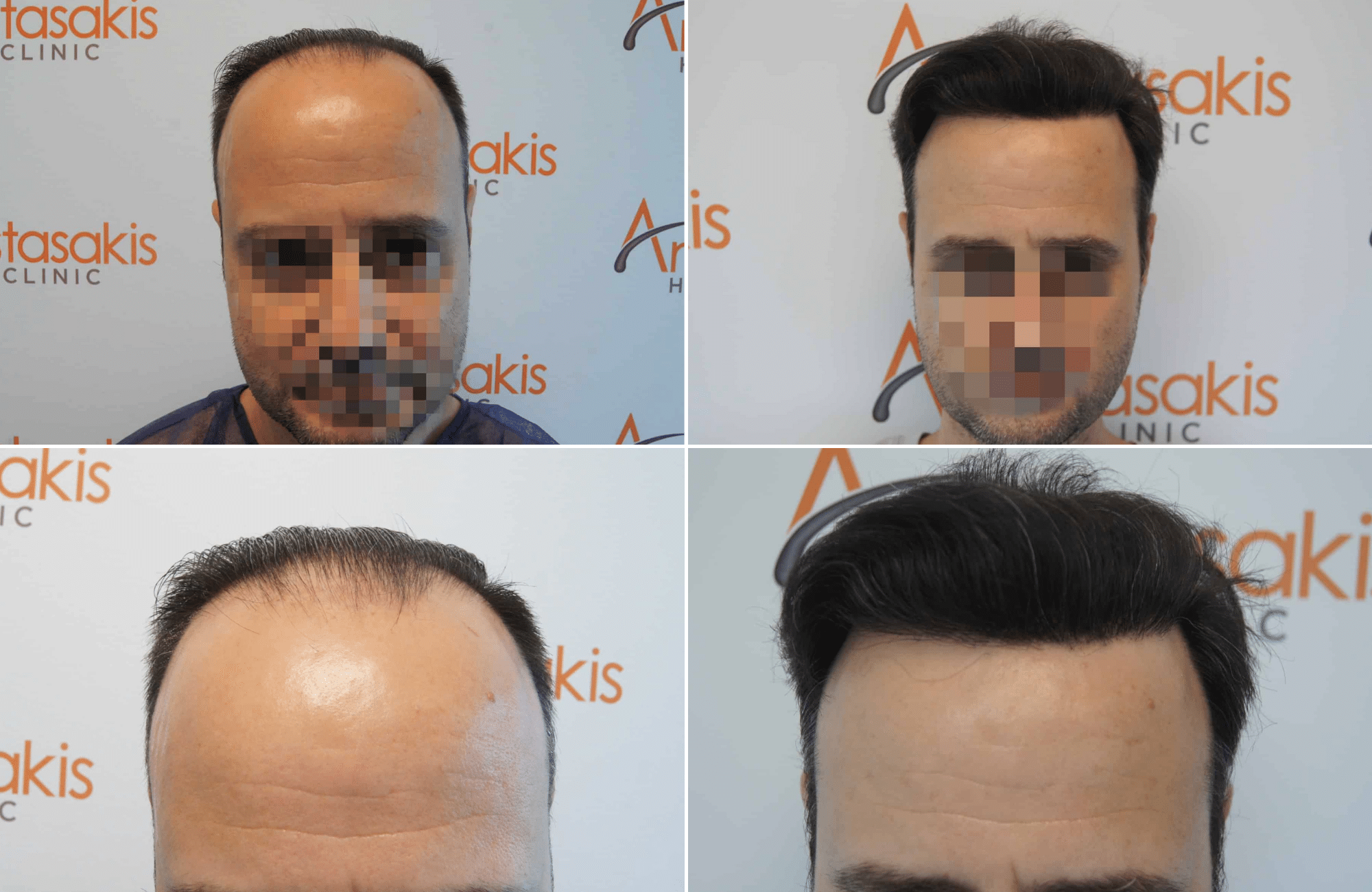 https://www.anastasakishairclinic.gr/portfolio/apotelesma-metamosxefsis-mallion-anastasakis-hair-clinic-312/