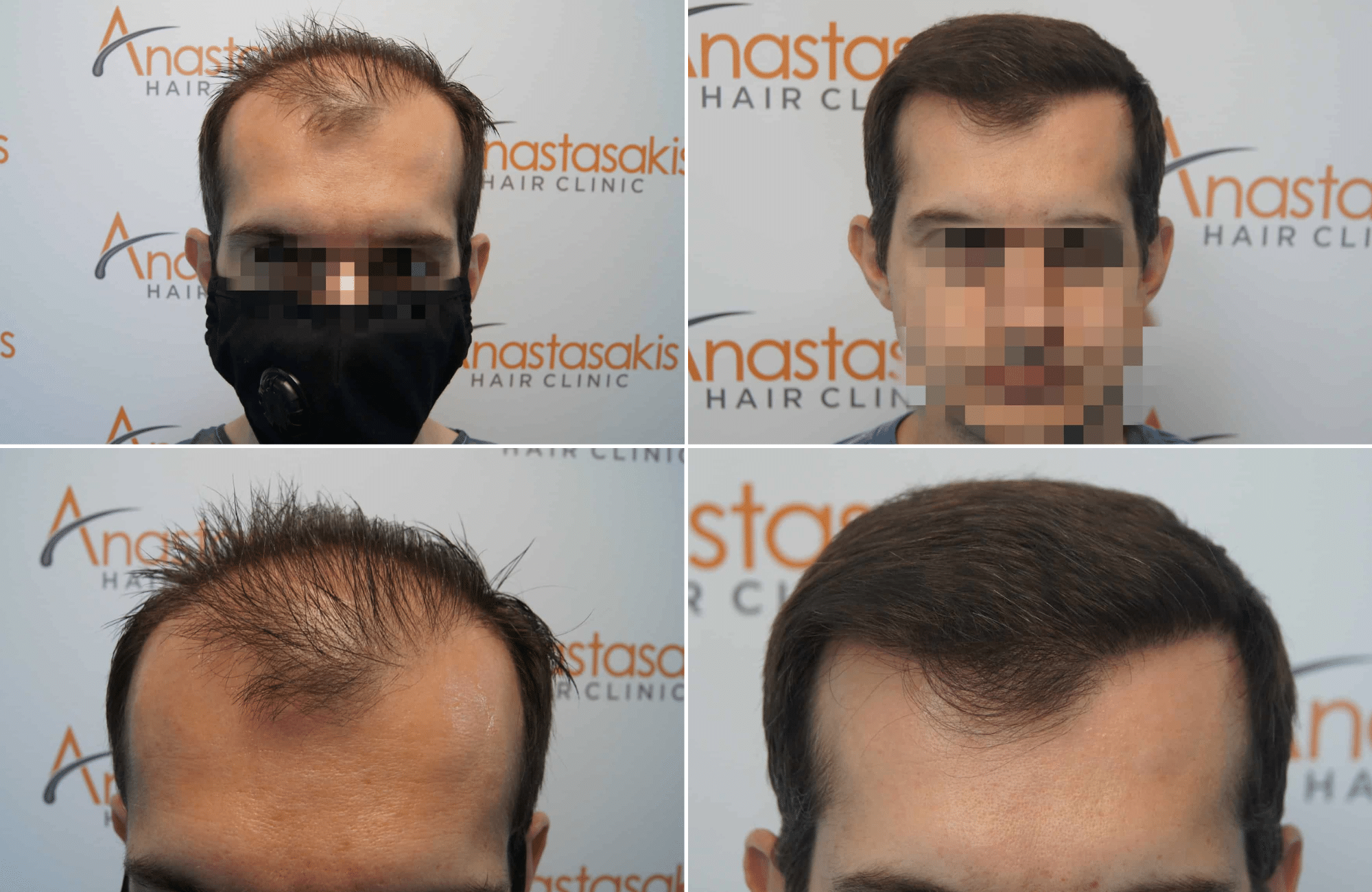 https://www.anastasakishairclinic.gr/portfolio/apotelesma-metamosxefsis-mallion-anastasakis-hair-clinic-313/